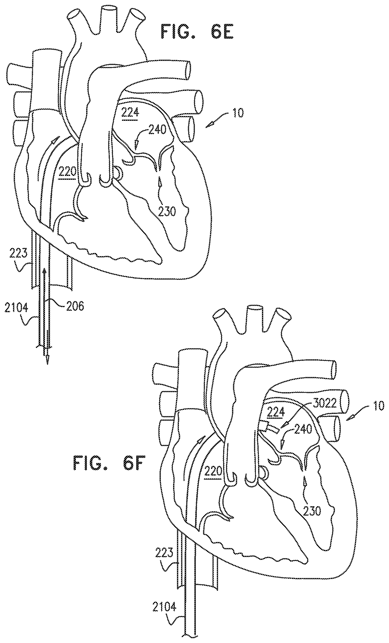 Patent US12350158 Figure 8 – Annuloplasty ring delivery catheters