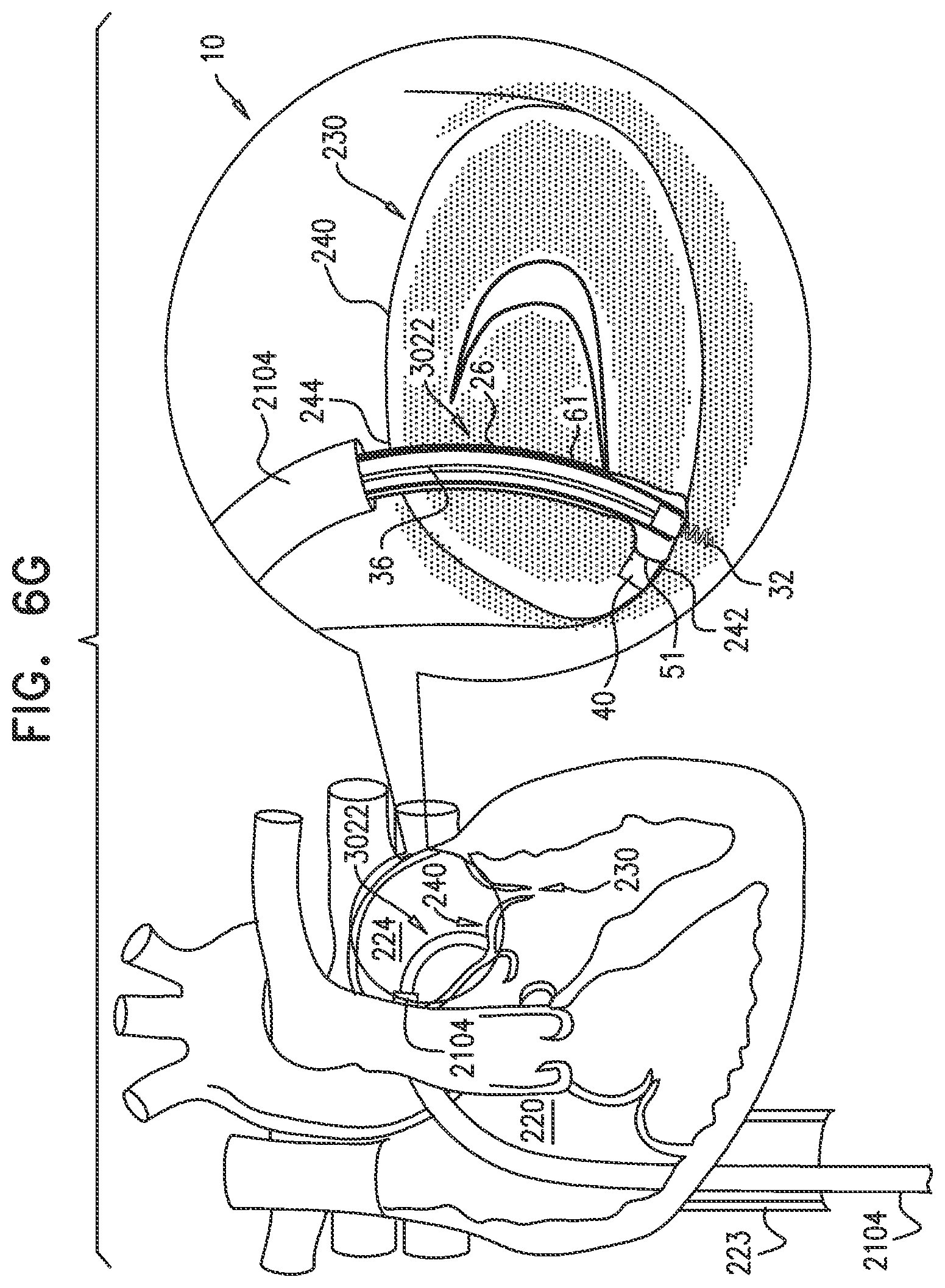 Patent US12350158 Figure 9 – Annuloplasty ring delivery catheters