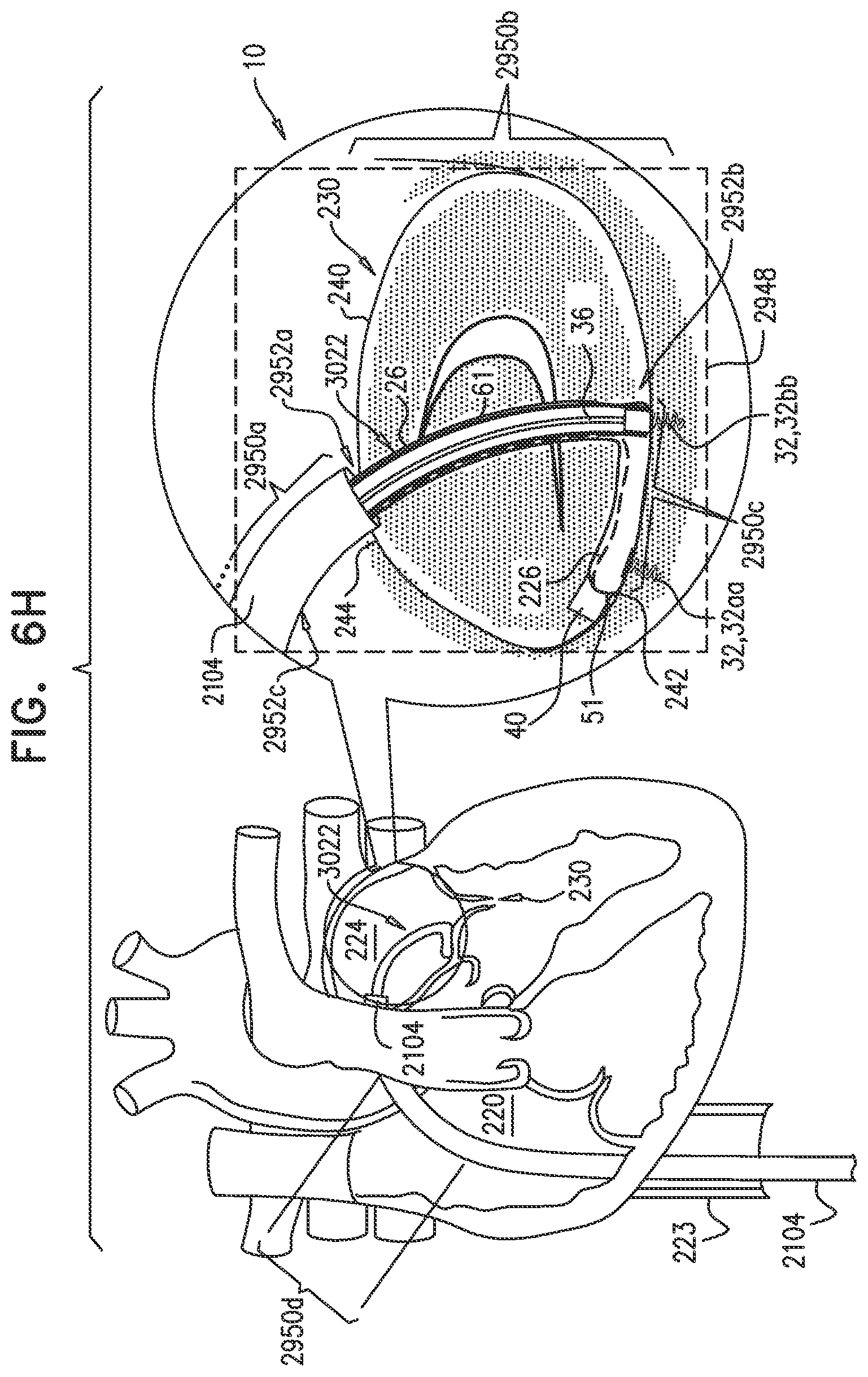 Patent US12350158 Figure 10 – Annuloplasty ring delivery catheters