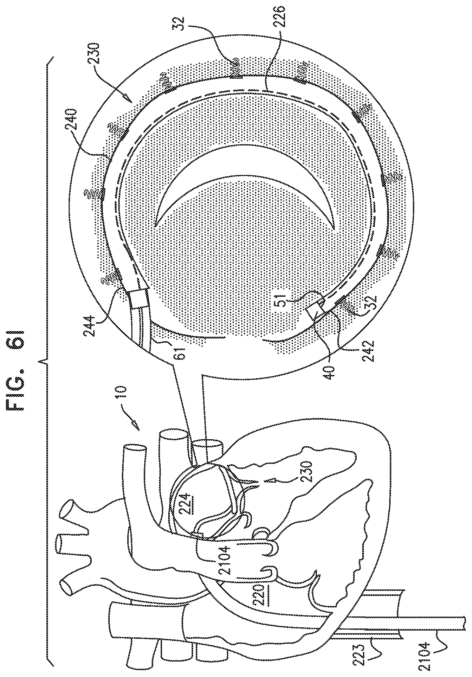 Patent US12350158 Figure 11 – Annuloplasty ring delivery catheters