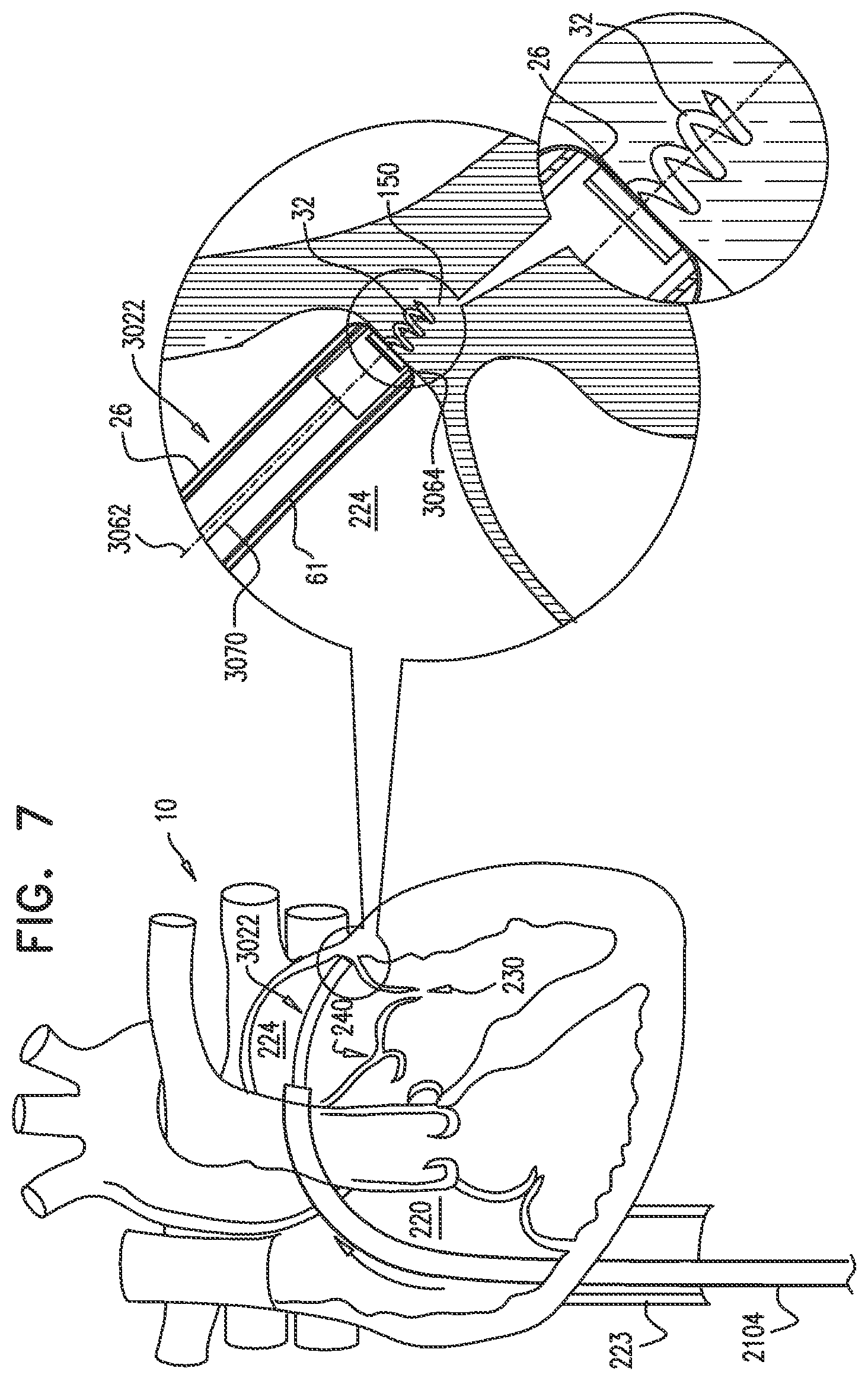 Patent US12350158 Figure 12 – Annuloplasty ring delivery catheters