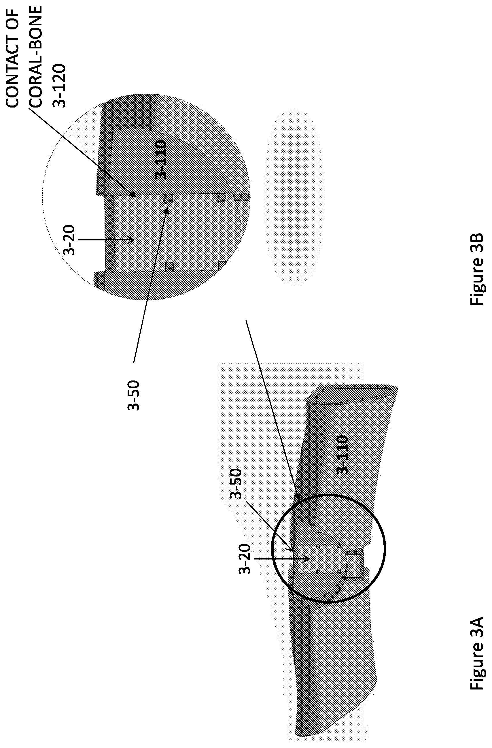 Patent US12350159 Figure 4 – Optimized cage systems promoting bone repair and fusion