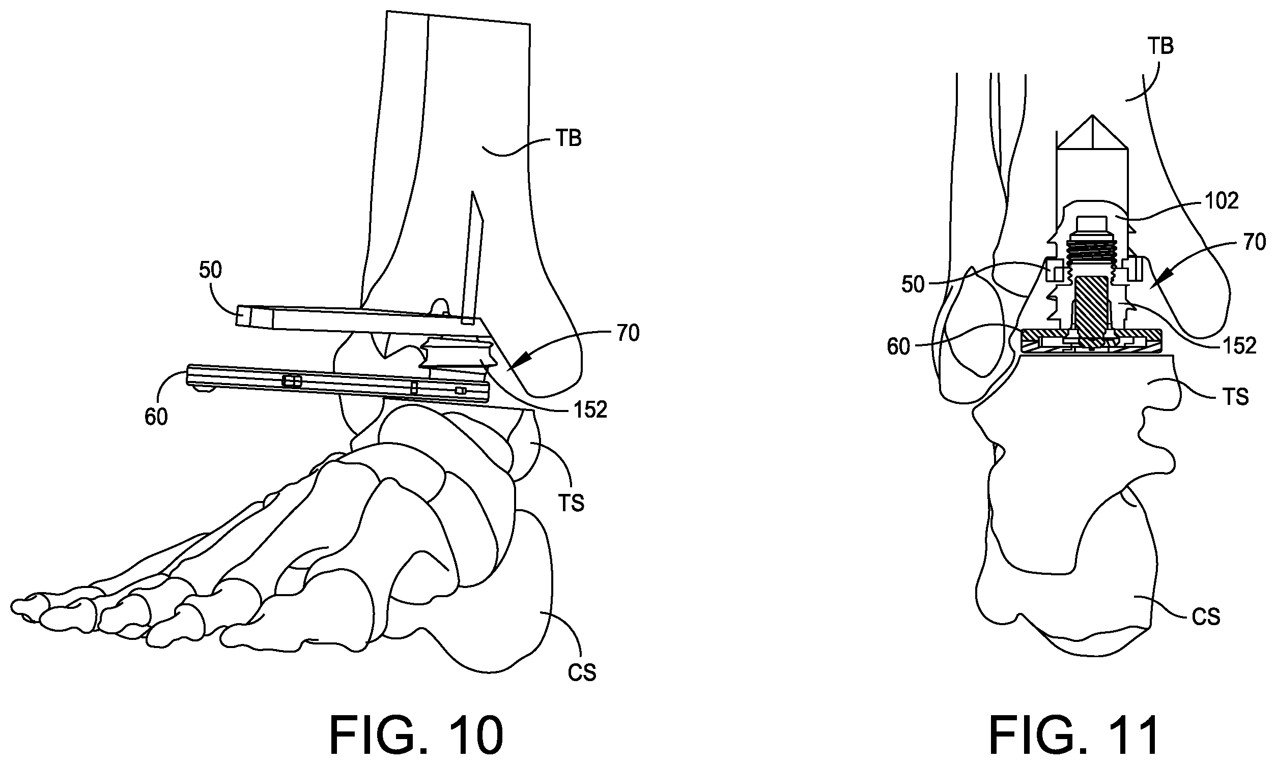 Patent US12350160 Figure 5 – Modular implant with external fixation