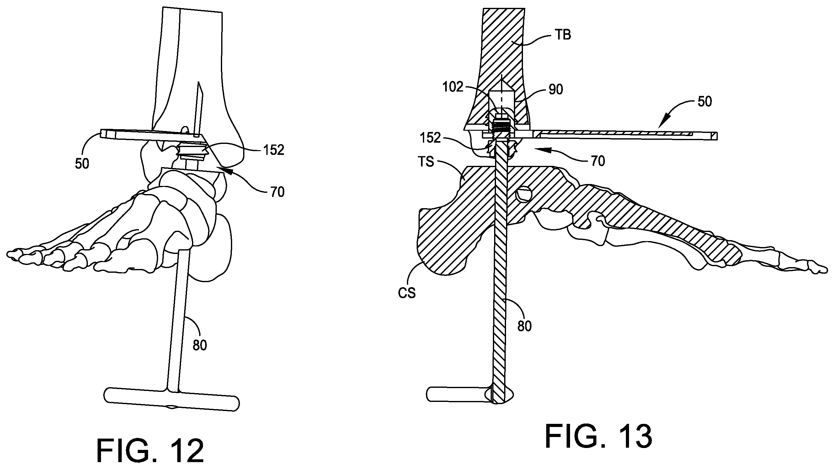 Patent US12350160 Figure 6 – Modular implant with external fixation