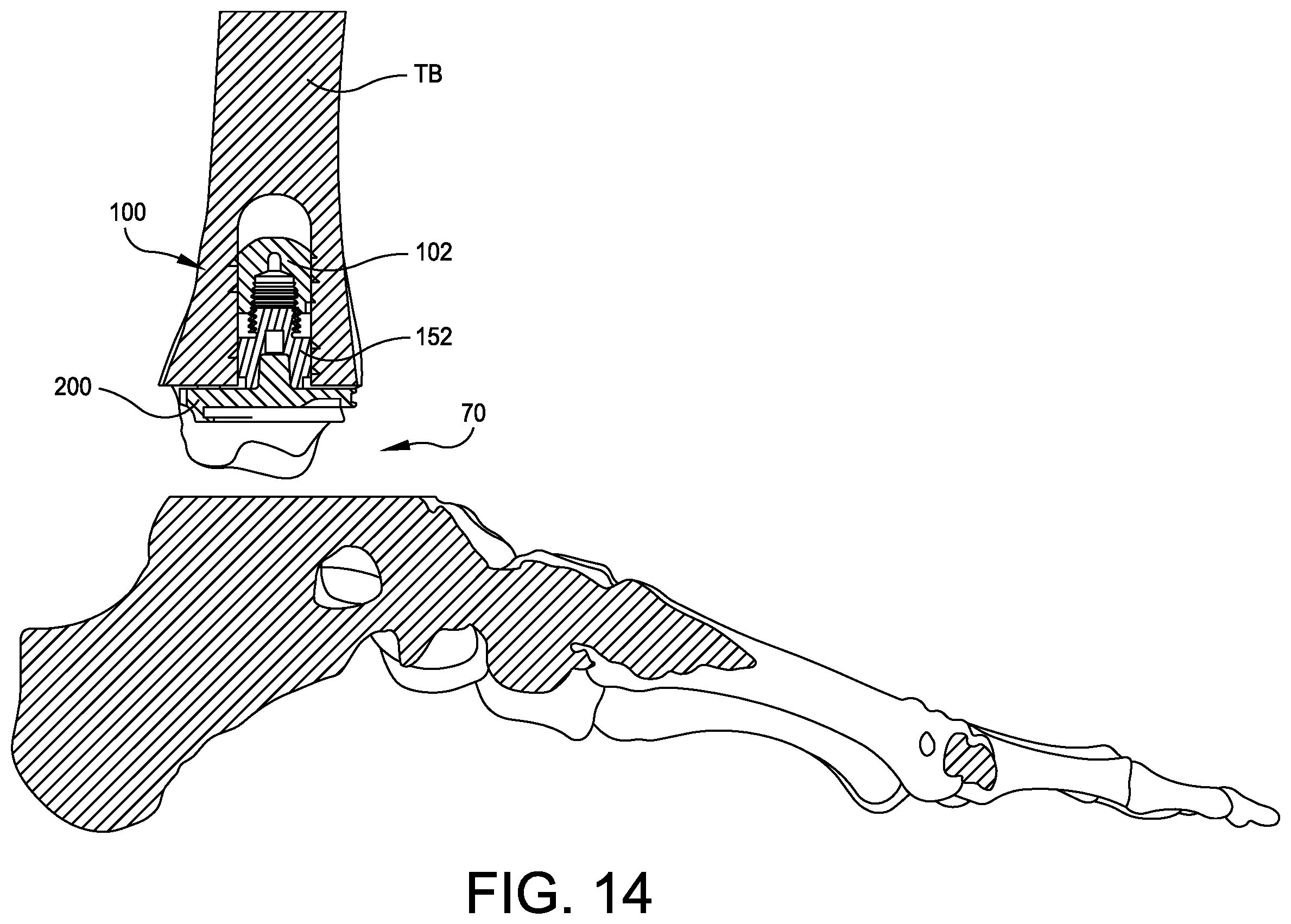 Patent US12350160 Figure 7 – Modular implant with external fixation