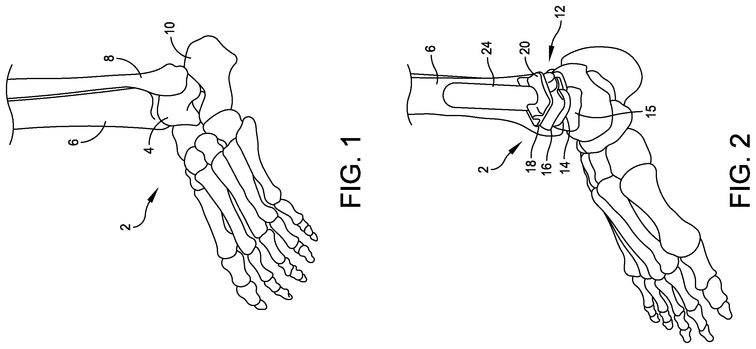 Patent US12350163 — Modular talar fixation method and system — Figure 1