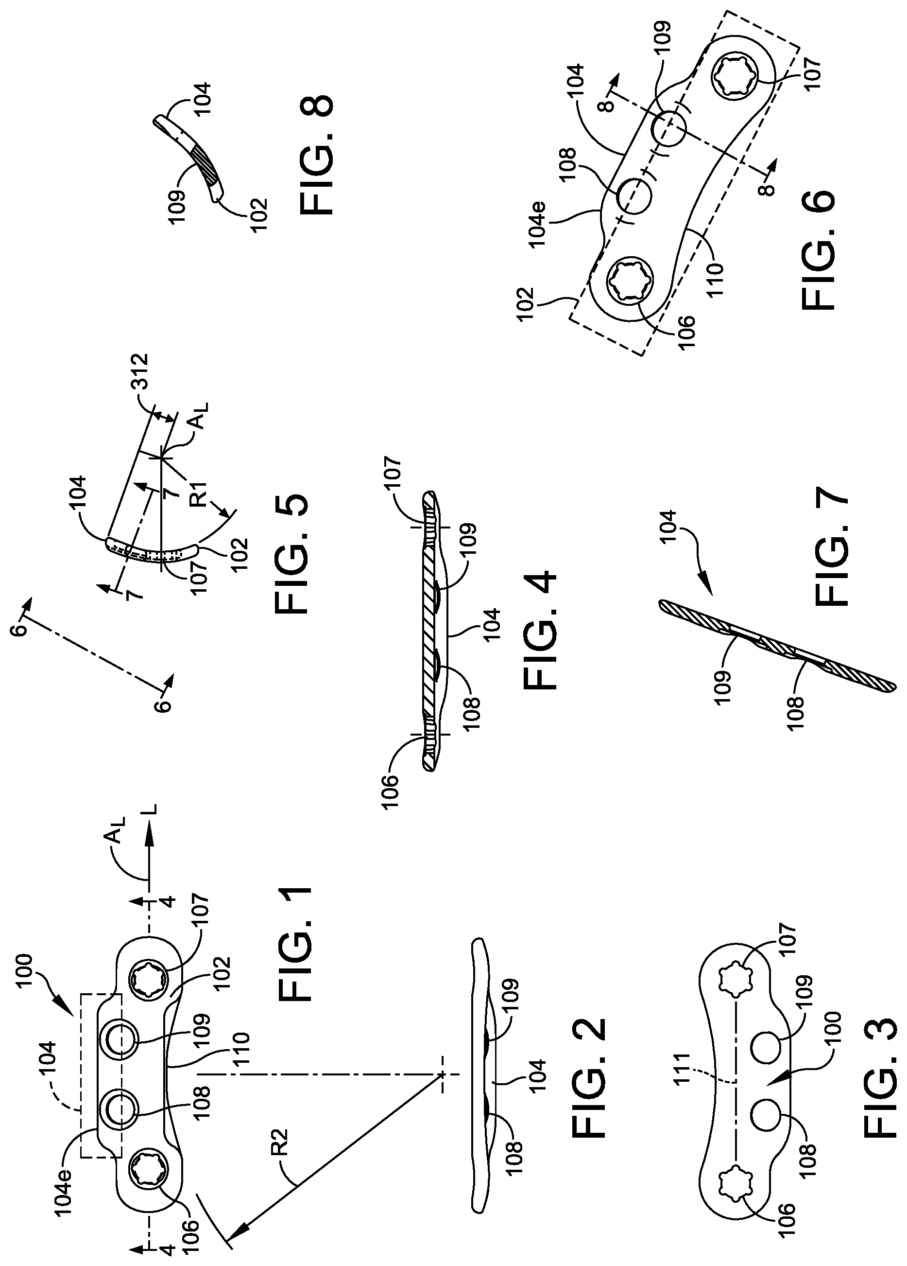 Patent US12350164 Figure 1 – Implant and method for ankle syndemosis treatment