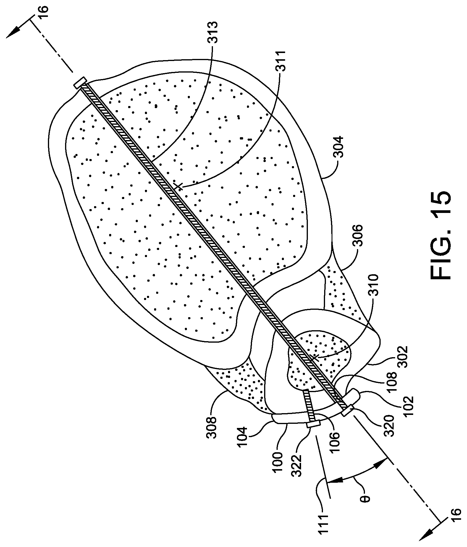 Patent US12350164 Figure 4 – Implant and method for ankle syndemosis treatment