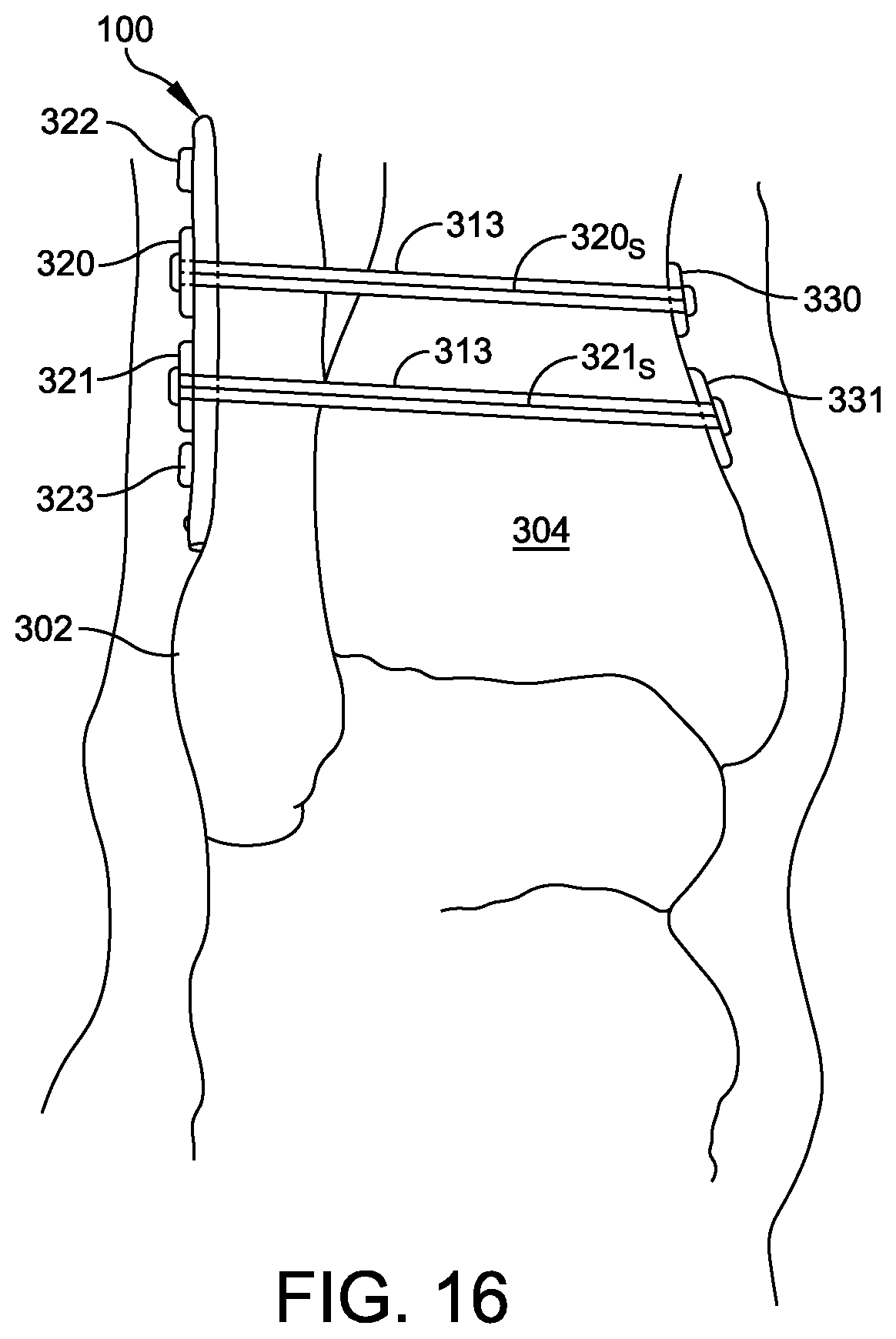 Patent US12350164 Figure 5 – Implant and method for ankle syndemosis treatment