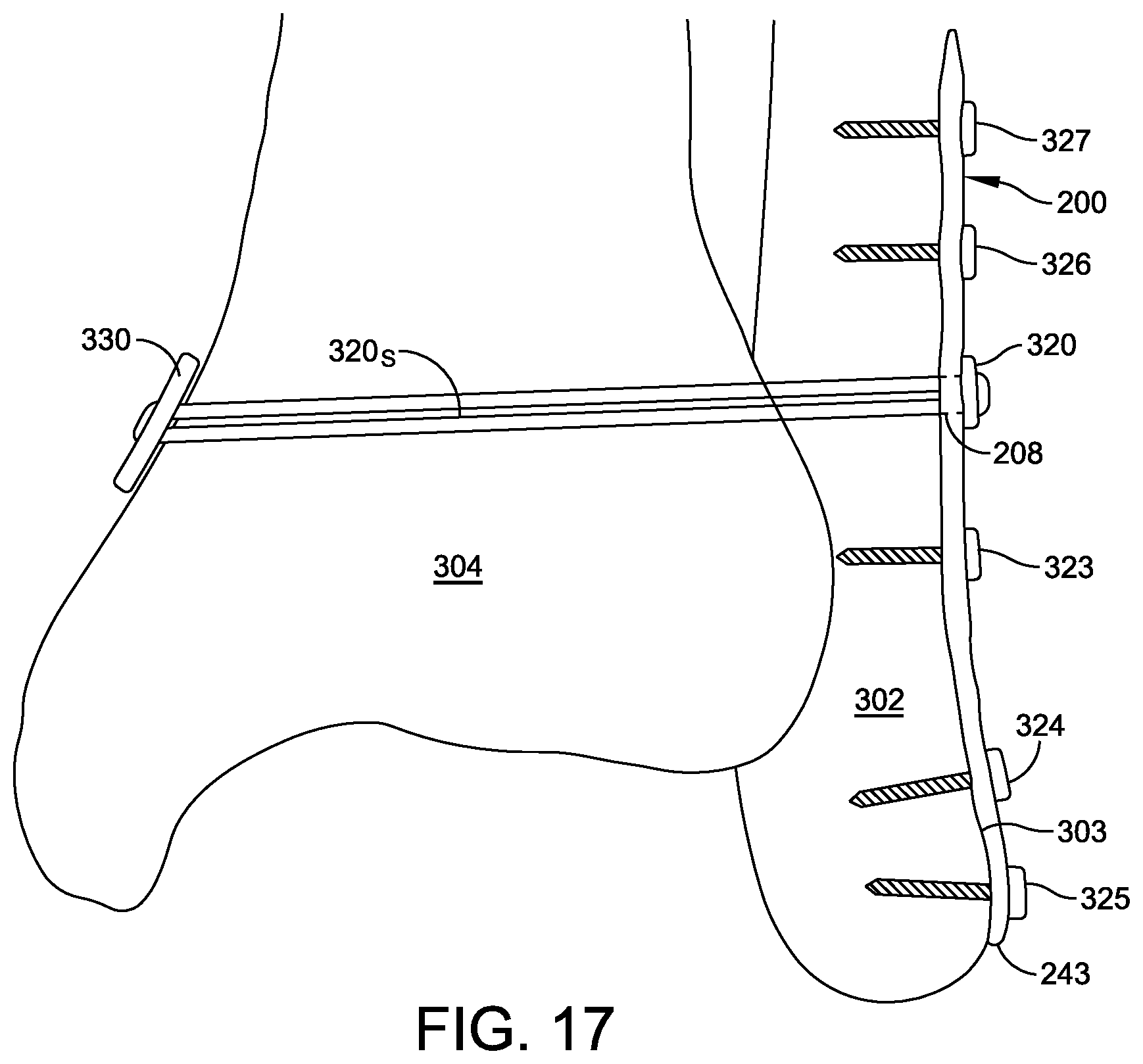 Patent US12350164 Figure 6 – Implant and method for ankle syndemosis treatment