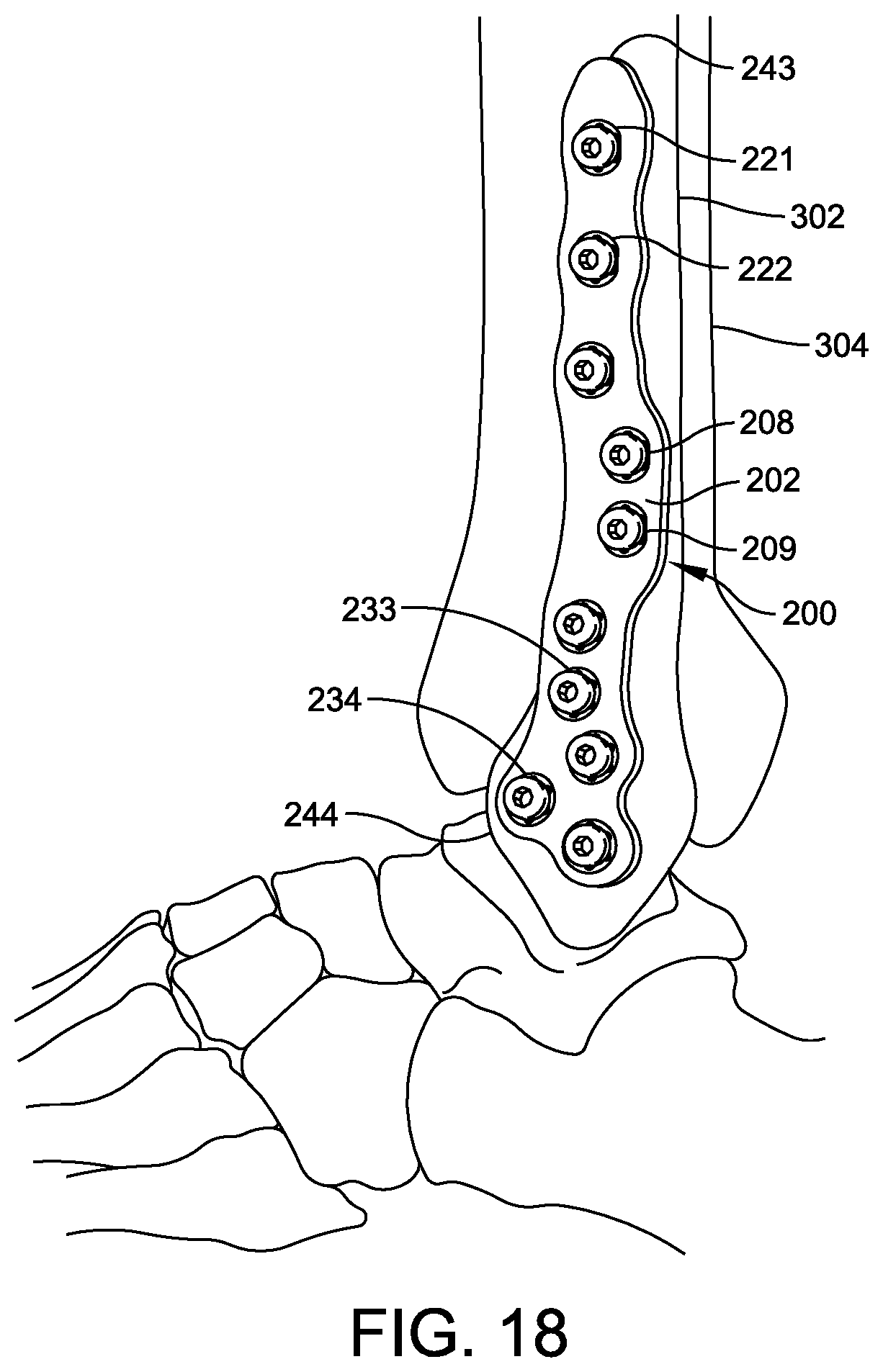 Patent US12350164 Figure 7 – Implant and method for ankle syndemosis treatment