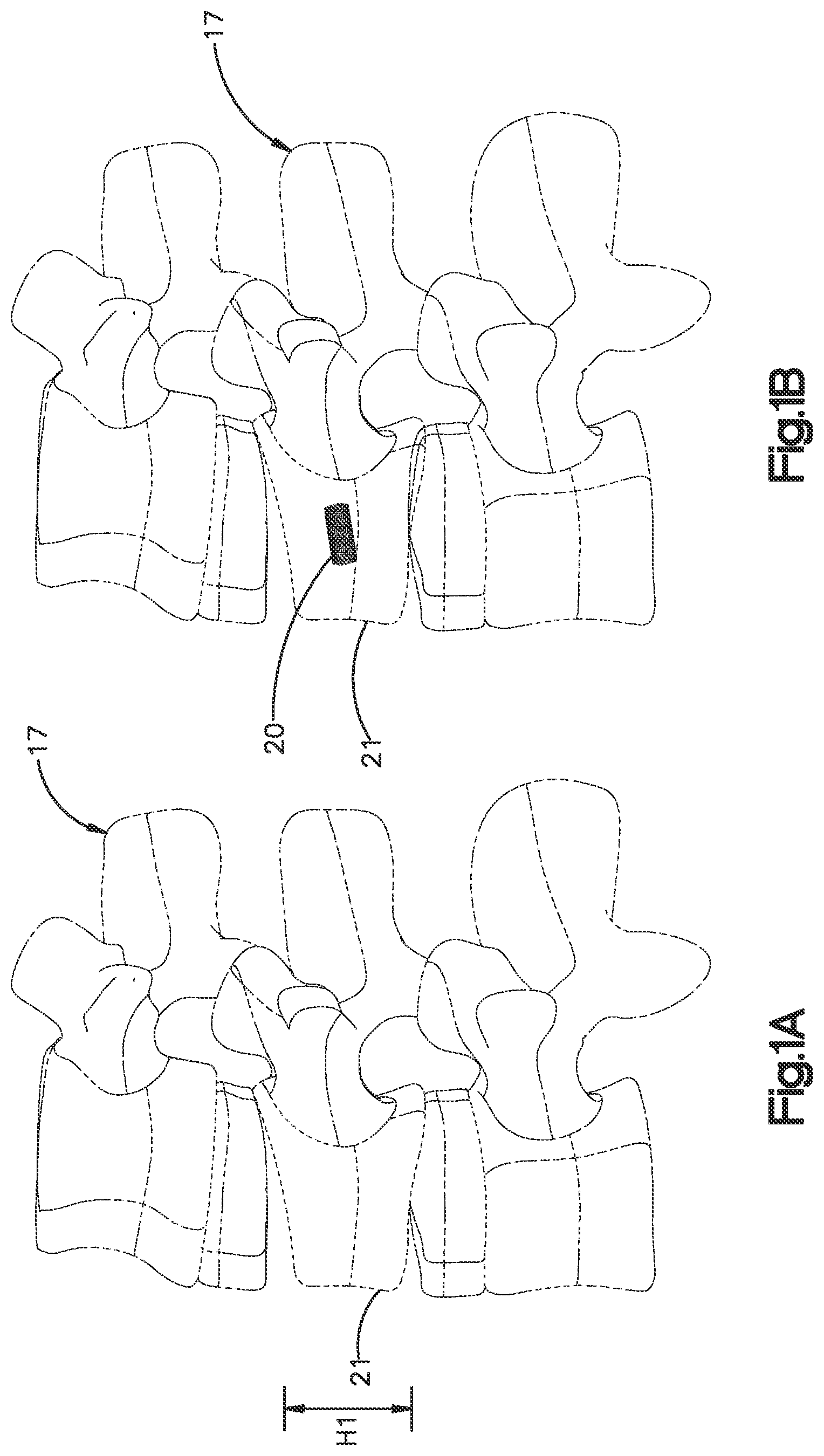 Patent US12350166 Figure 1 – Method and apparatus for augmenting bone
