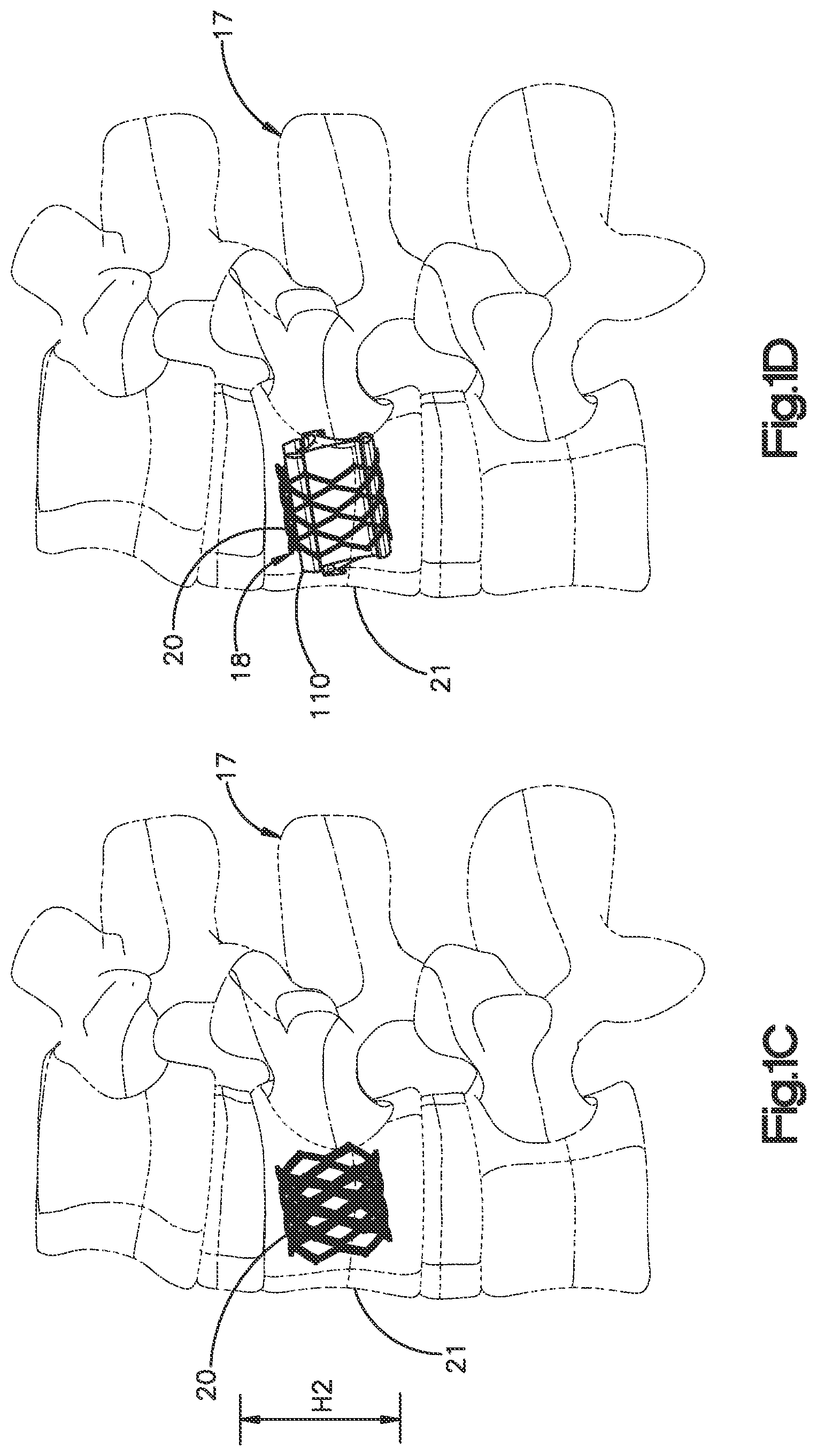 Patent US12350166 Figure 2 – Method and apparatus for augmenting bone