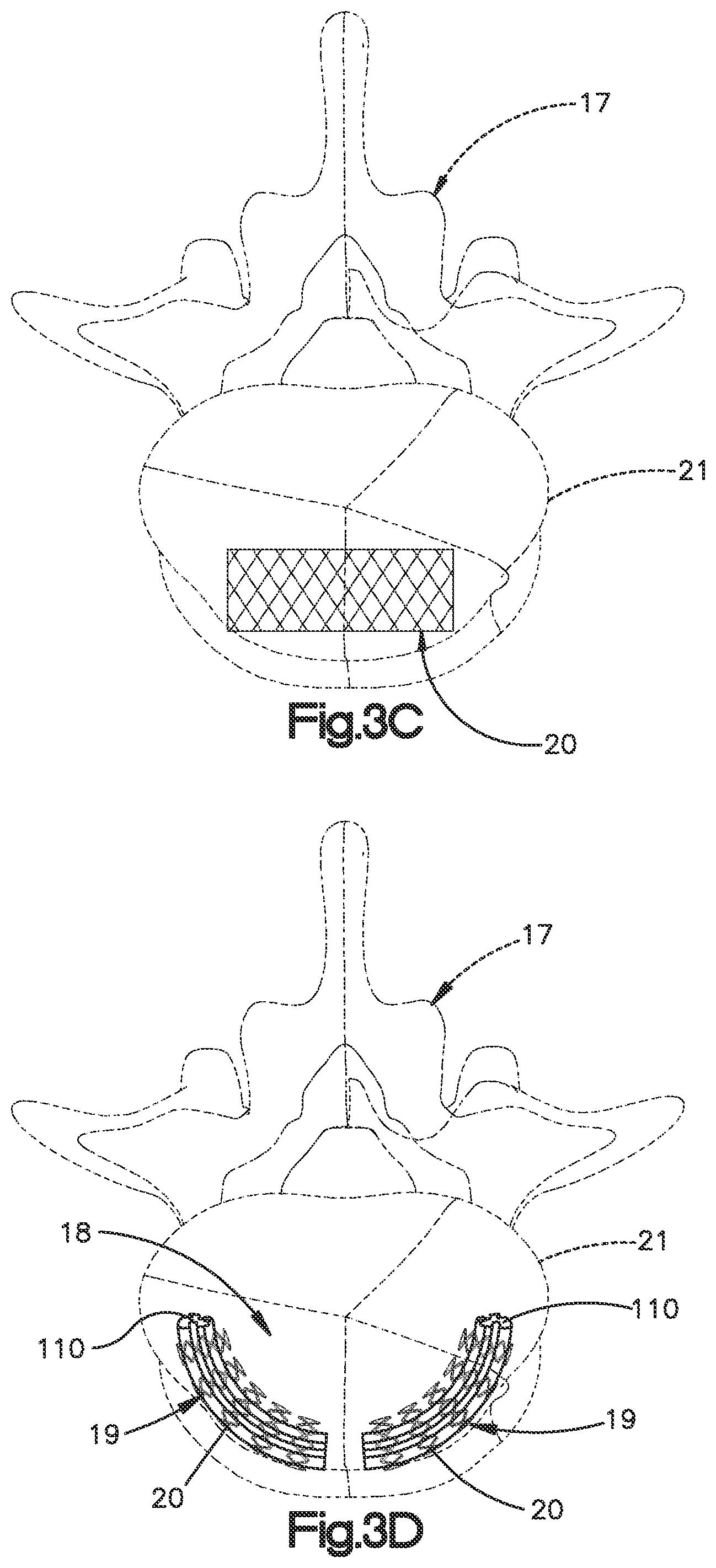 Patent US12350166 Figure 6 – Method and apparatus for augmenting bone