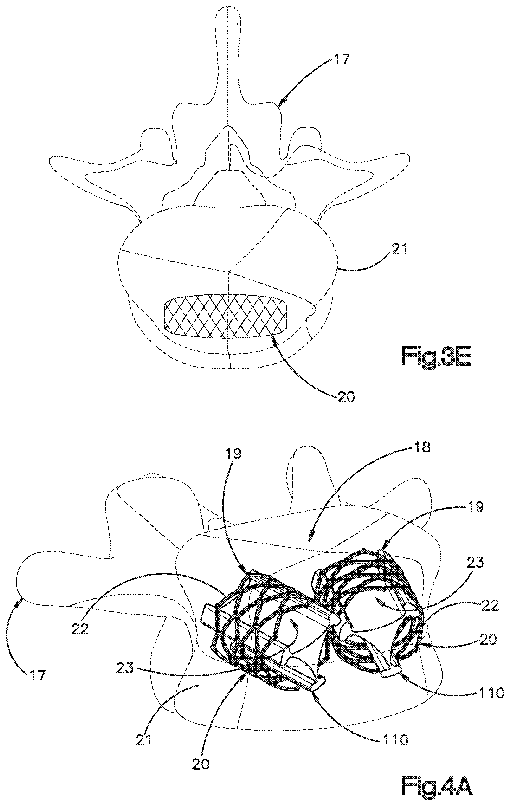 Patent US12350166 Figure 7 – Method and apparatus for augmenting bone