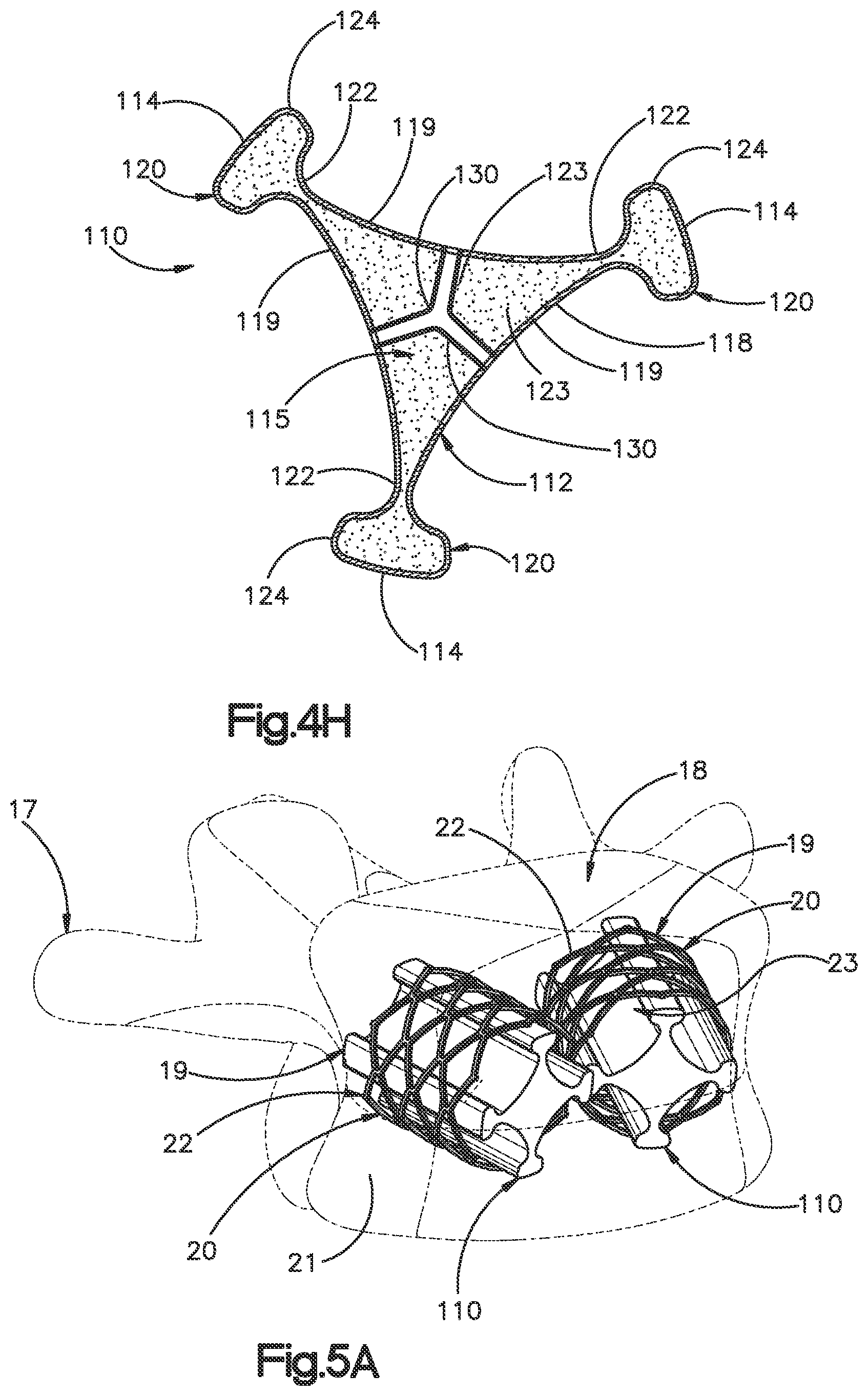Patent US12350166 Figure 11 – Method and apparatus for augmenting bone