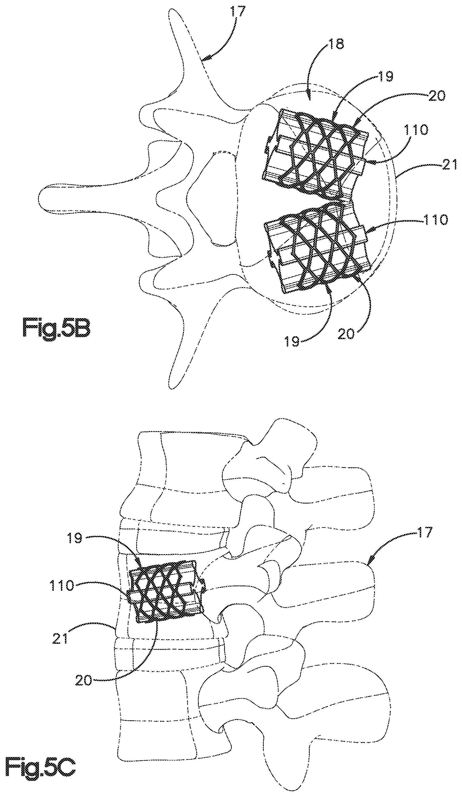 Patent US12350166 Figure 12 – Method and apparatus for augmenting bone