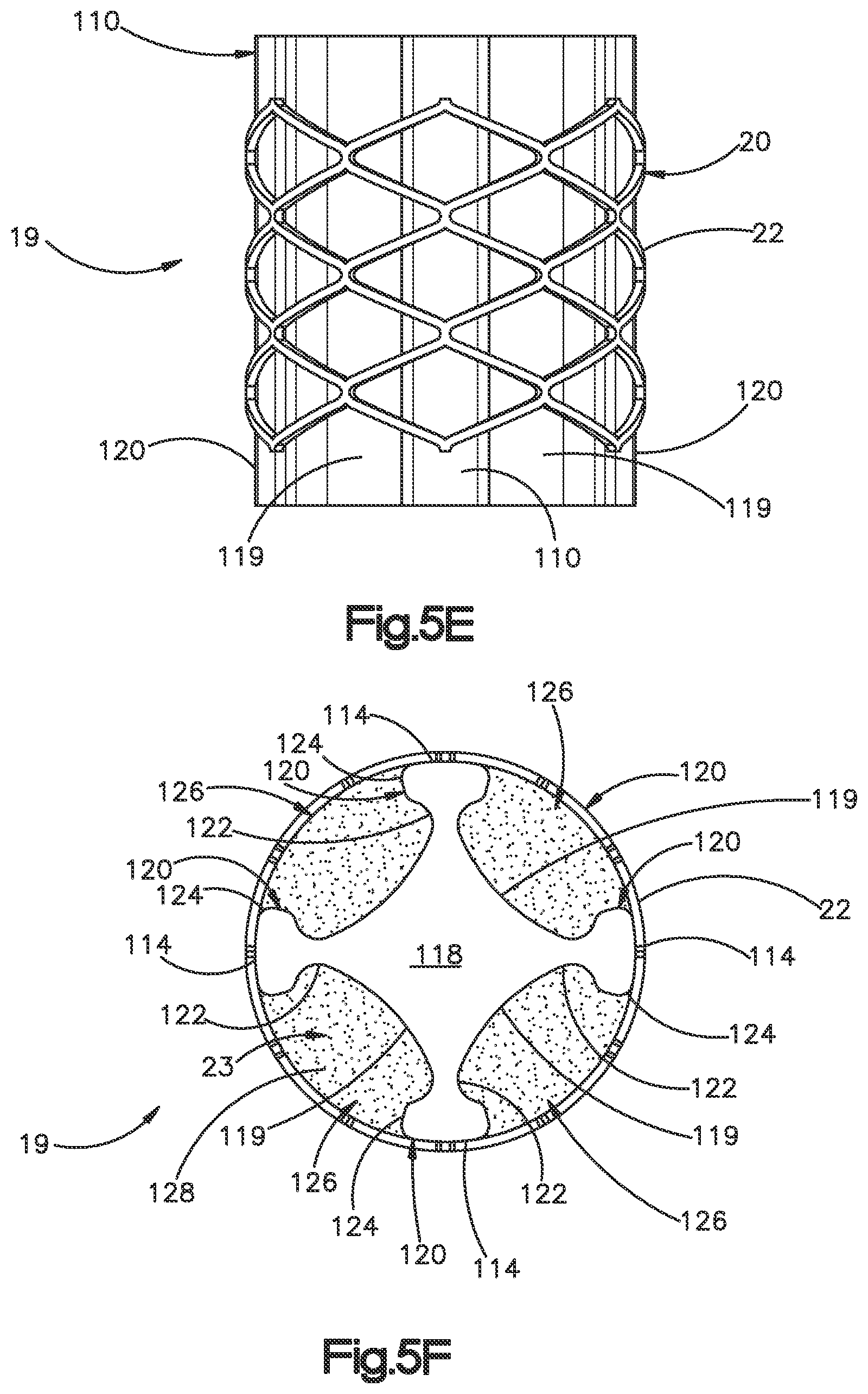 Patent US12350166 Figure 14 – Method and apparatus for augmenting bone