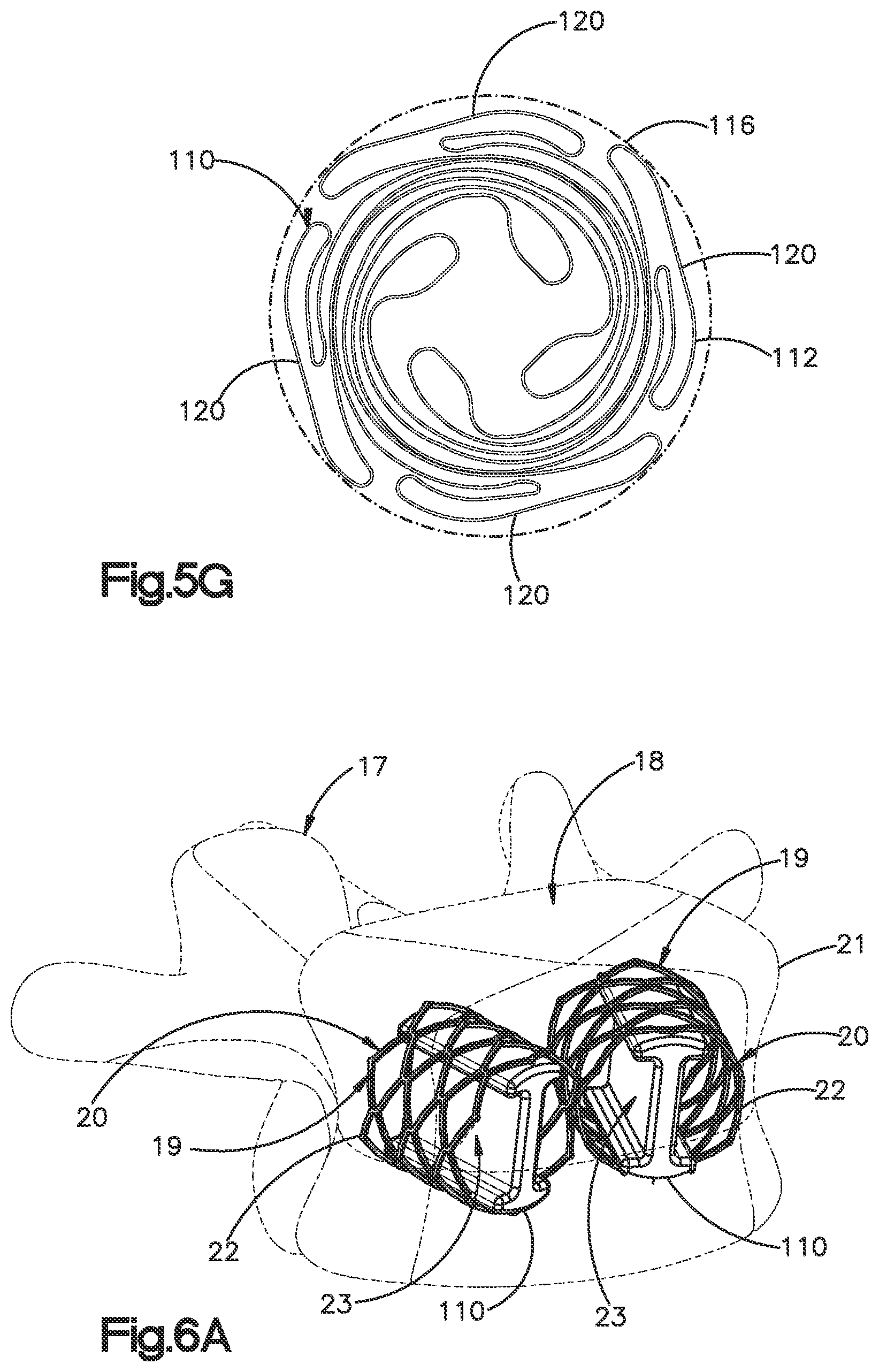 Patent US12350166 Figure 15 – Method and apparatus for augmenting bone