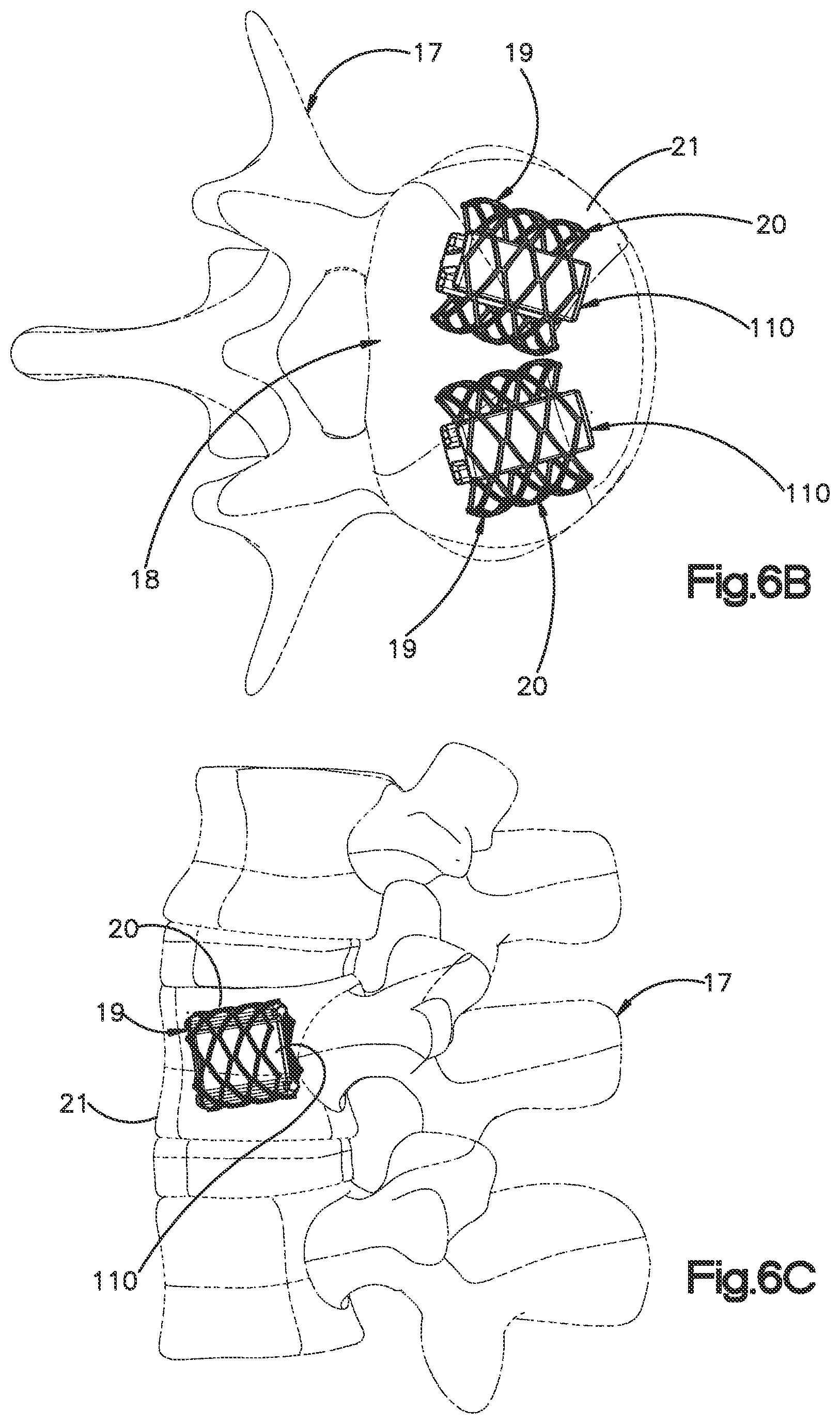 Patent US12350166 Figure 16 – Method and apparatus for augmenting bone
