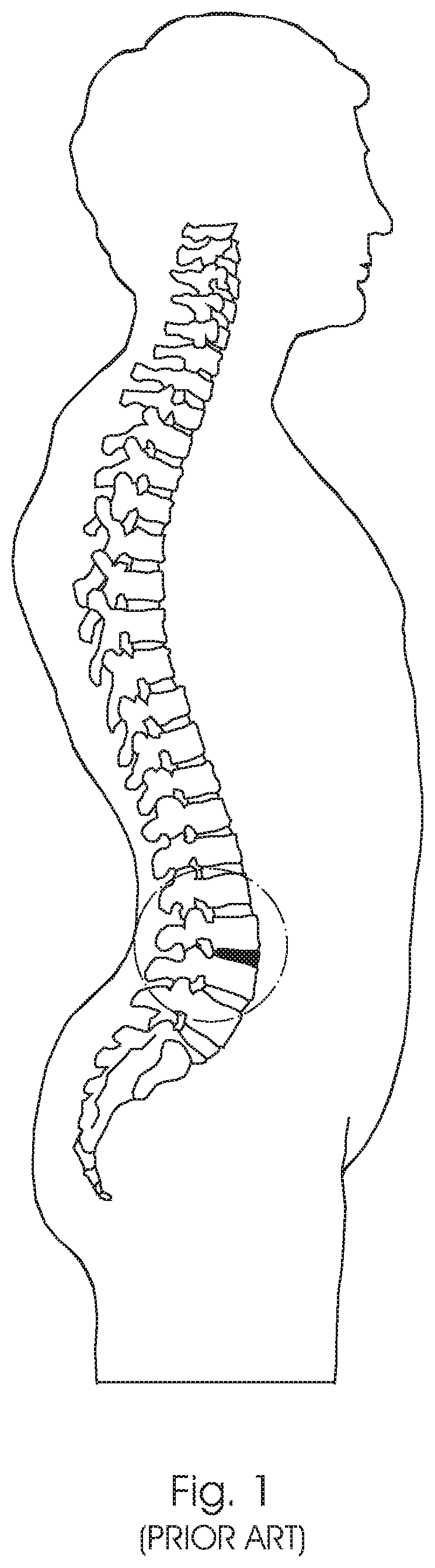 Patent US12350168 Figure 1 – Intervertebral fusion cage