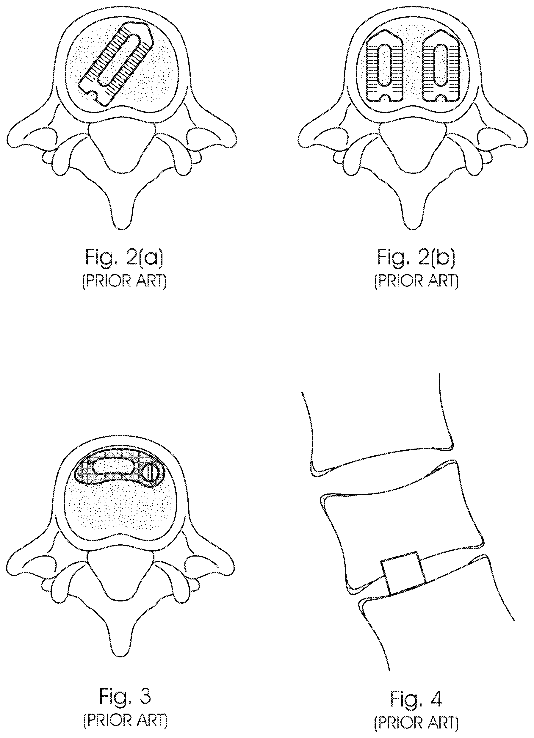 Patent US12350168 Figure 2 – Intervertebral fusion cage