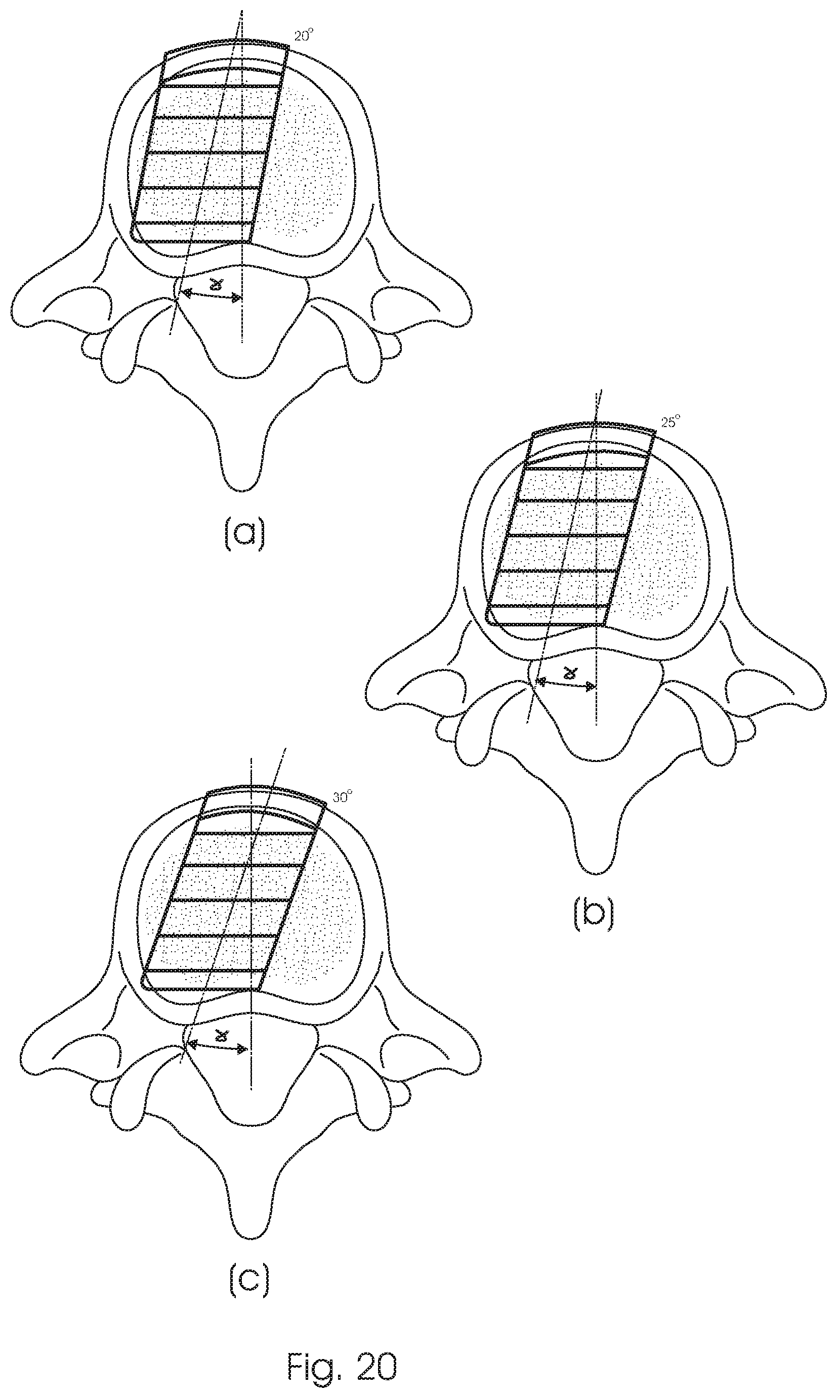 Patent US12350168 Figure 11 – Intervertebral fusion cage