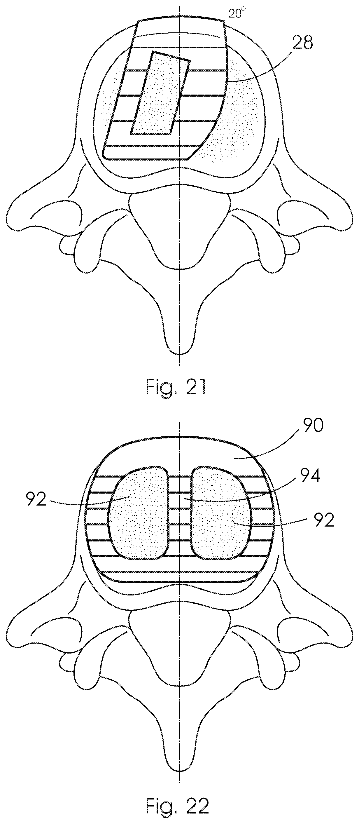 Patent US12350168 Figure 12 – Intervertebral fusion cage