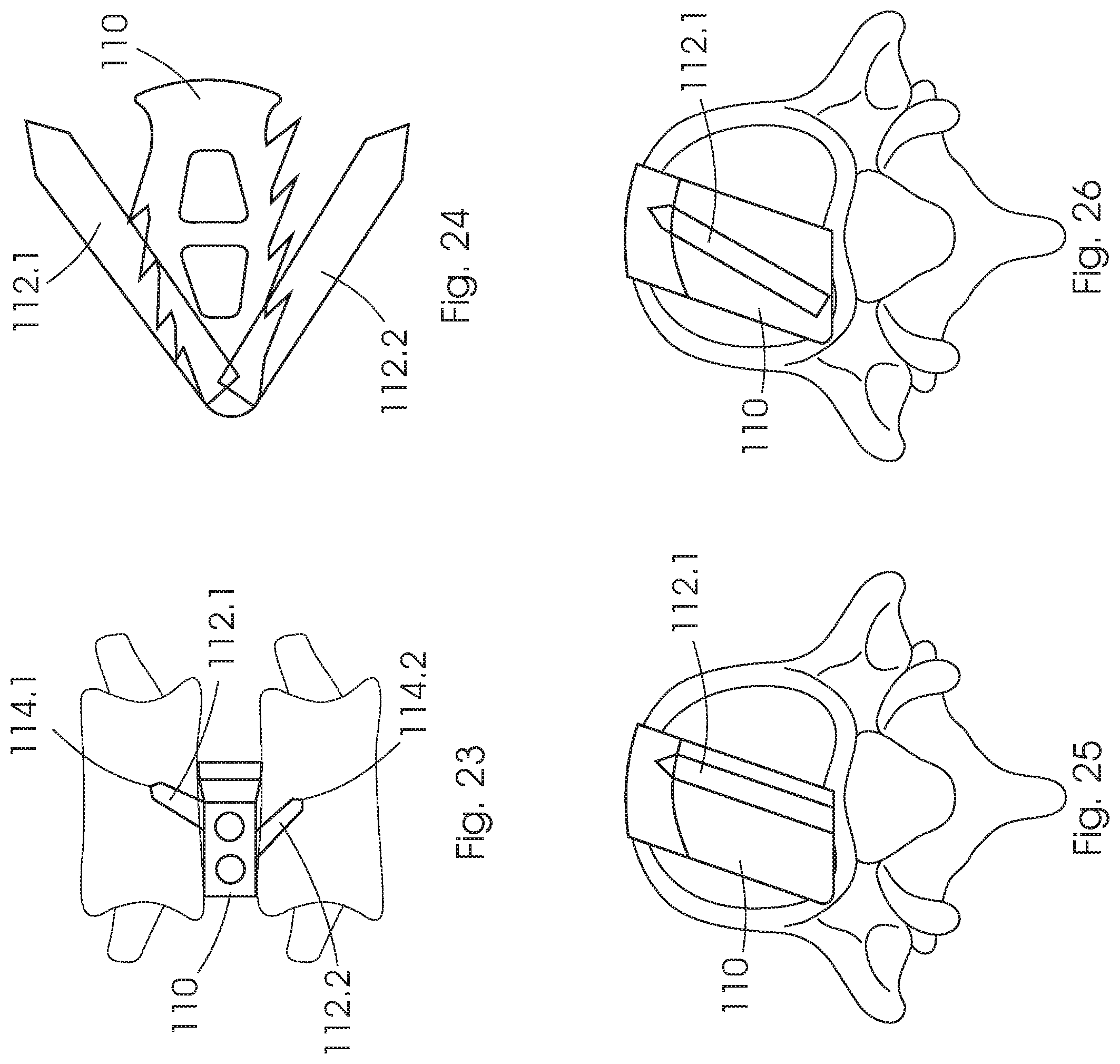 Patent US12350168 Figure 13 – Intervertebral fusion cage