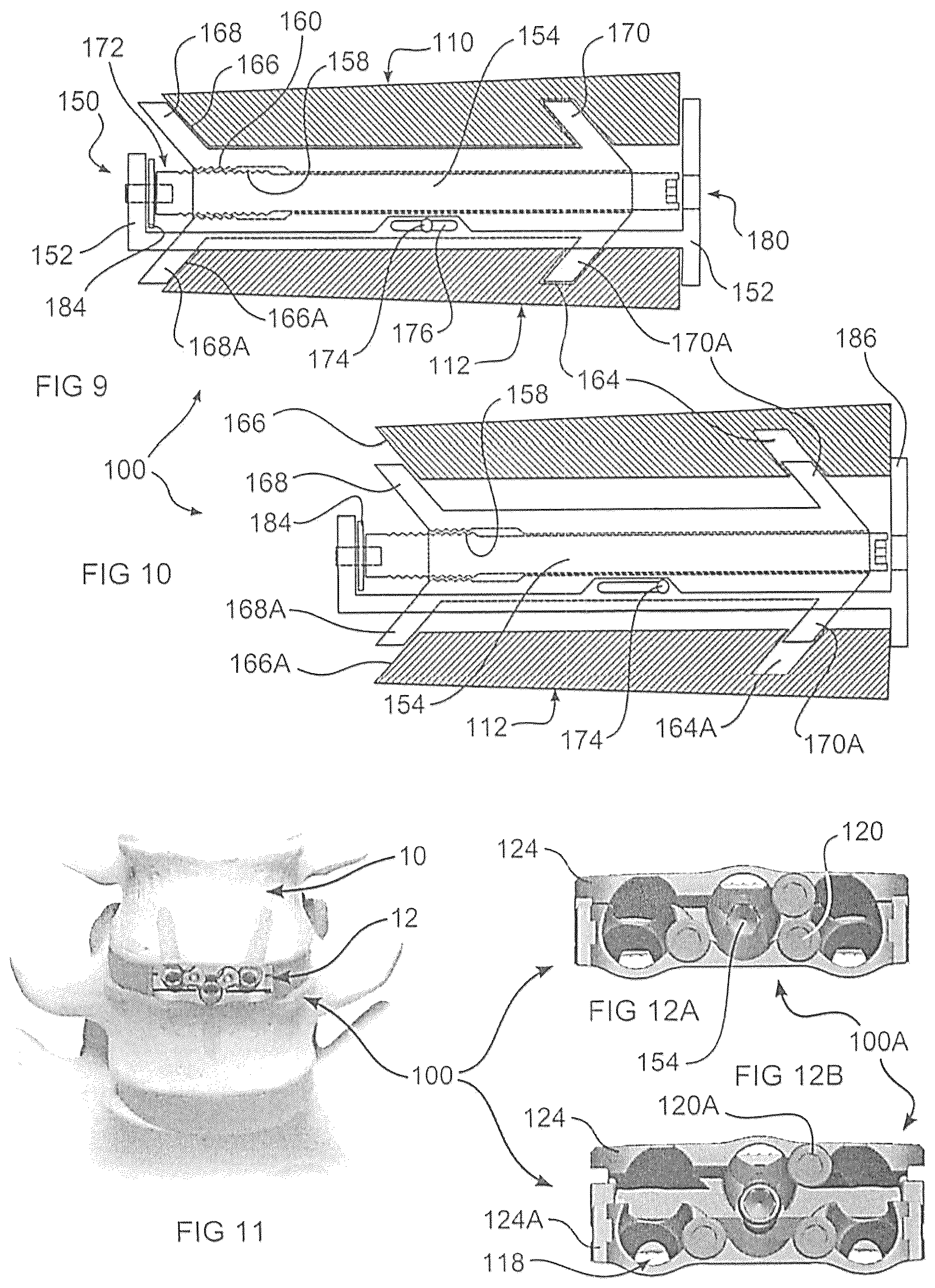 Patent US12350170 Figure 4 – Expandable intervertebral implant