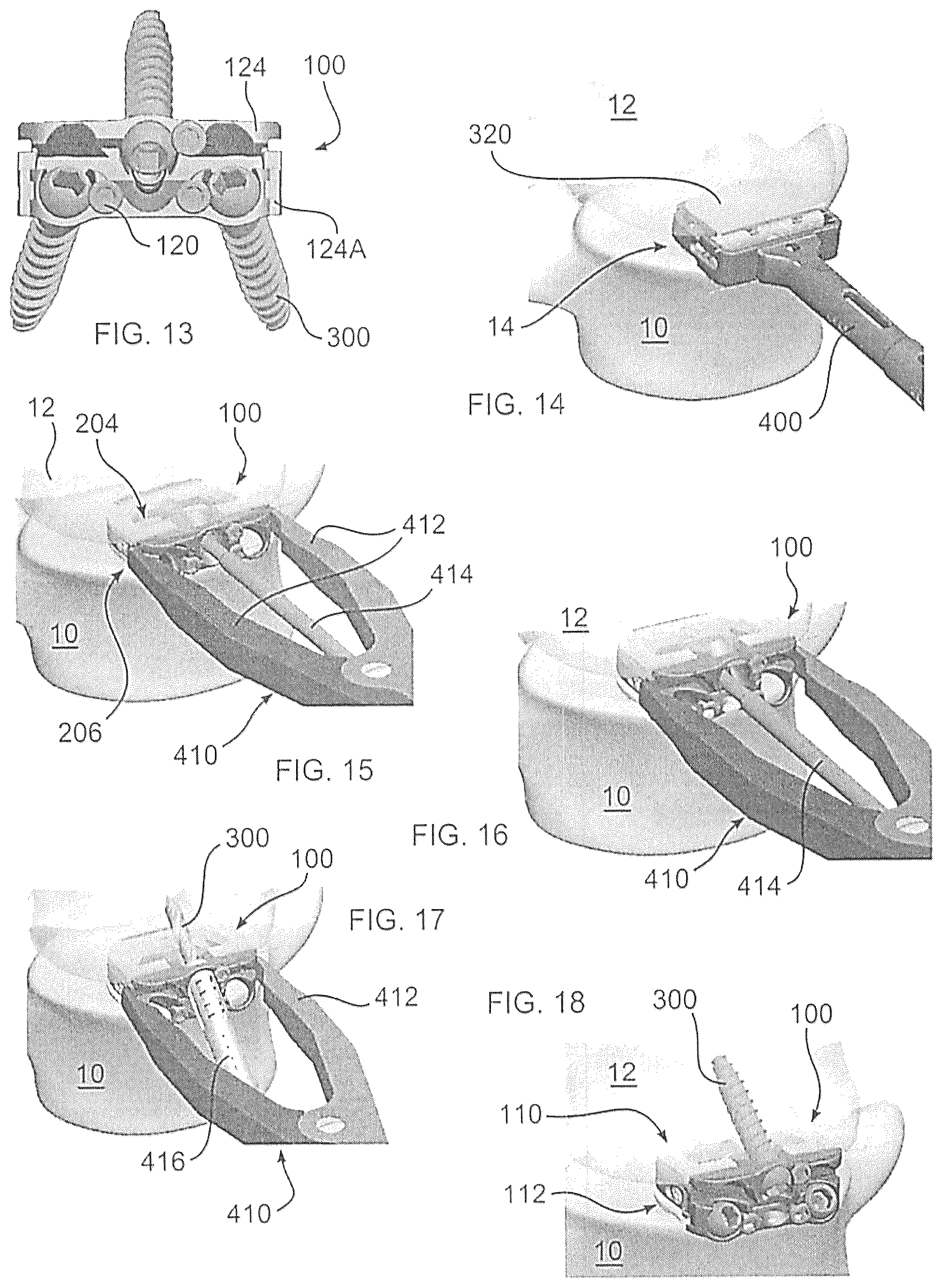 Patent US12350170 Figure 5 – Expandable intervertebral implant