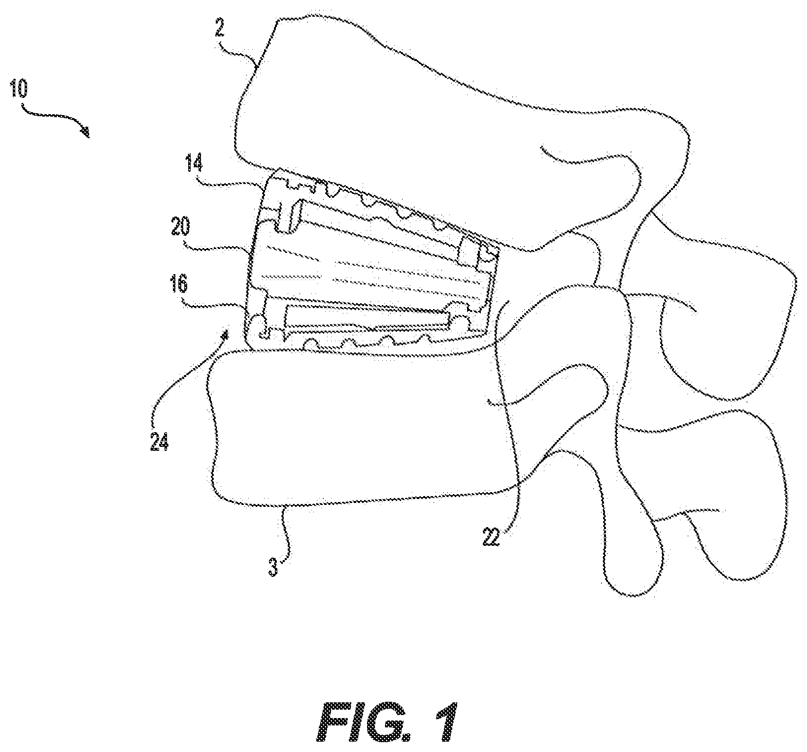 Patent US12350171 Figure 1 – Variable lordosis spacer and related methods of use