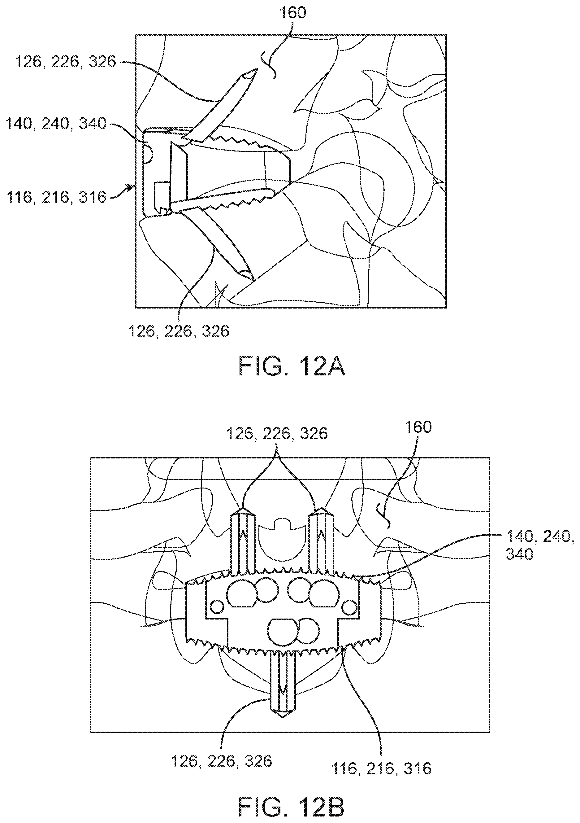 Patent US12350174 Figure 10 – Fixation member inserter instrument