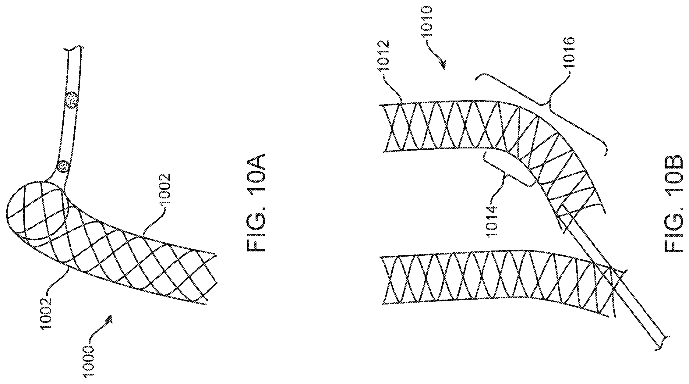 Patent US12350178 Figure 9 – Stent braid pattern with enhanced radiopacity