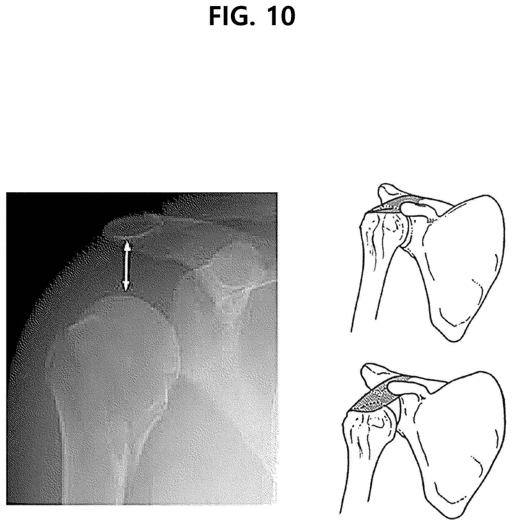 Patent US12350186 Figure 12 – Non-fixed shoulder brace