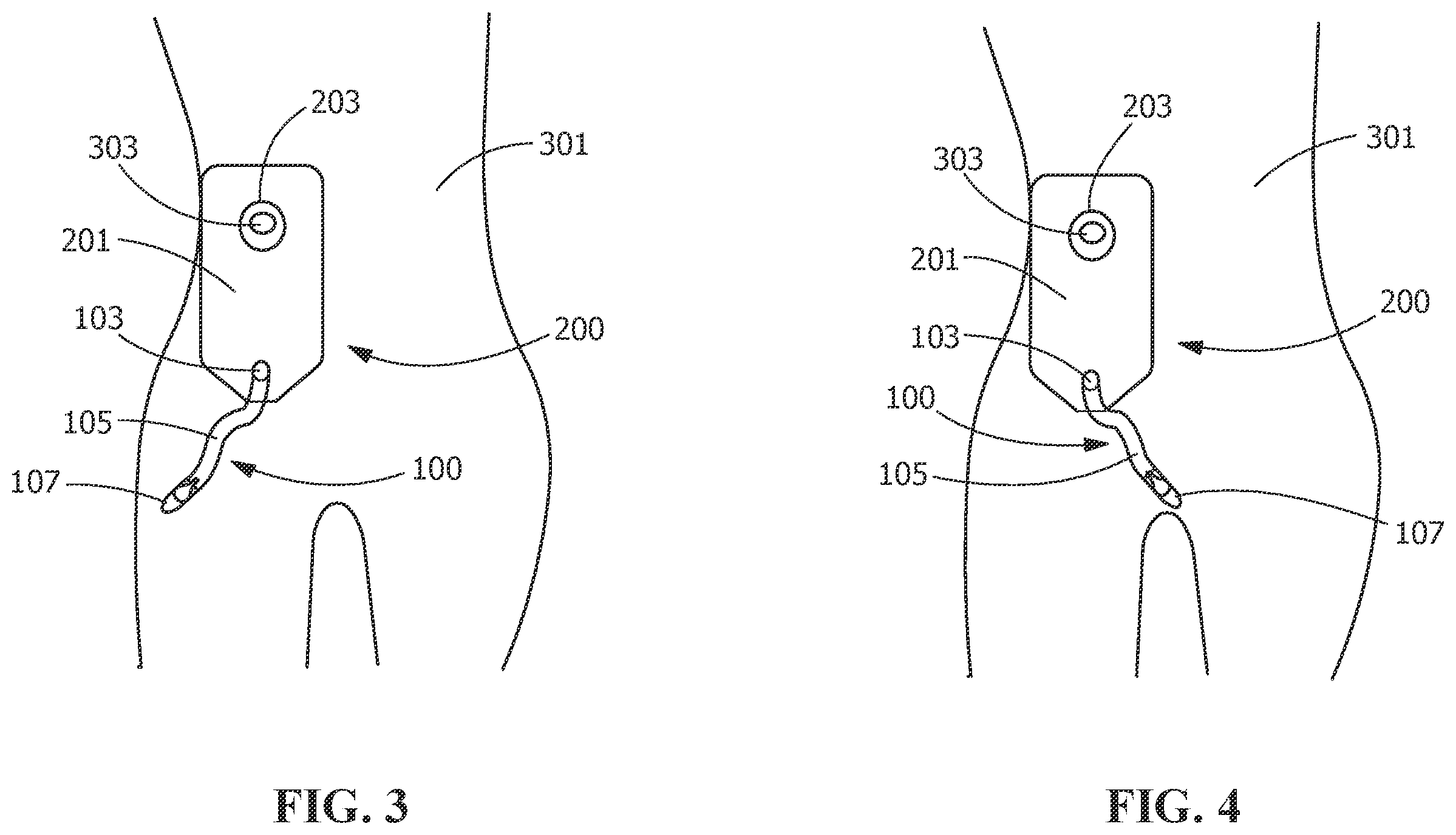 Patent US12350188 Figure 3 – Drain asembly for elimination of urine waste from an ostomy bag