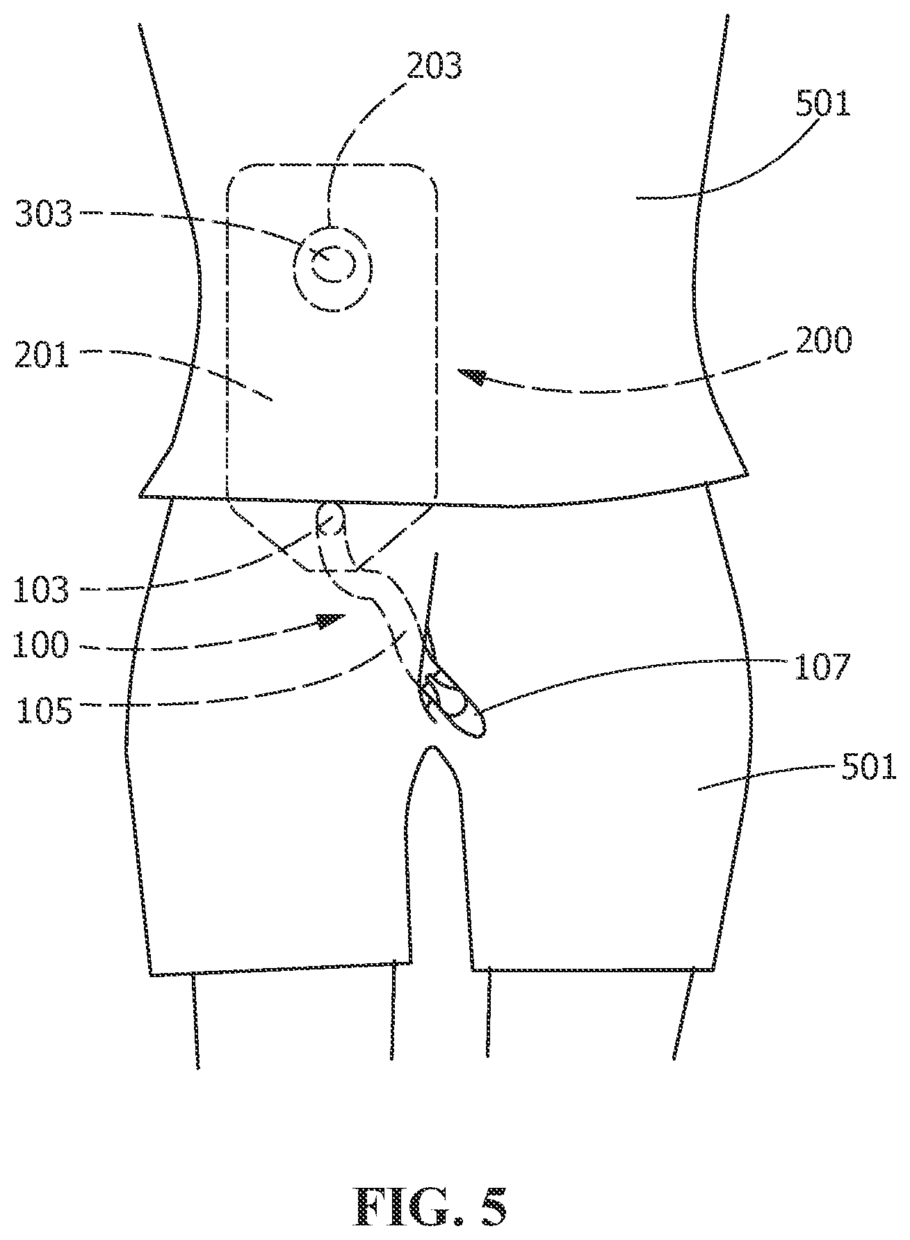 Patent US12350188 Figure 4 – Drain asembly for elimination of urine waste from an ostomy bag
