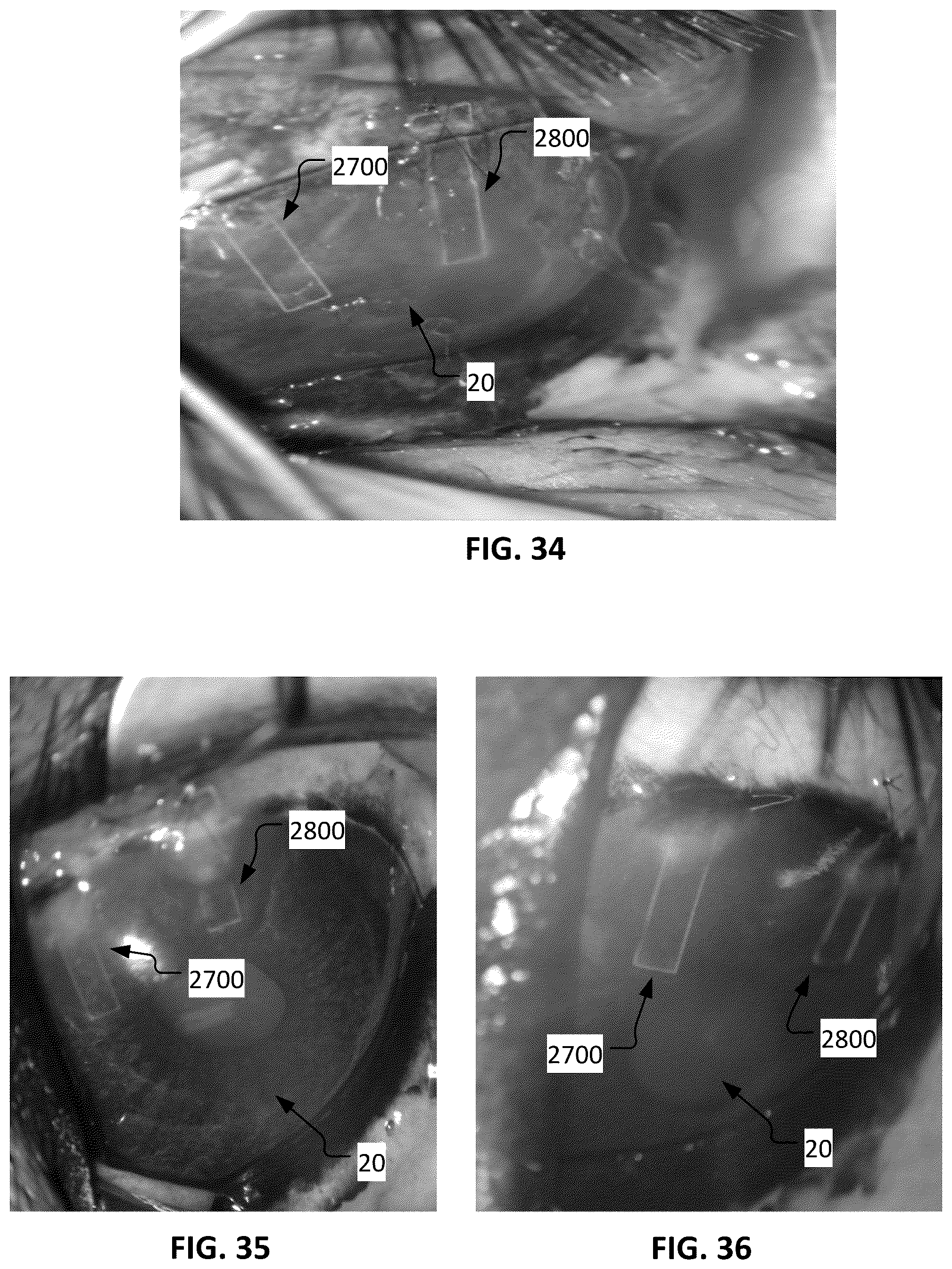 Patent US12350193 Figure 18 – Dry eye treatment devices and methods