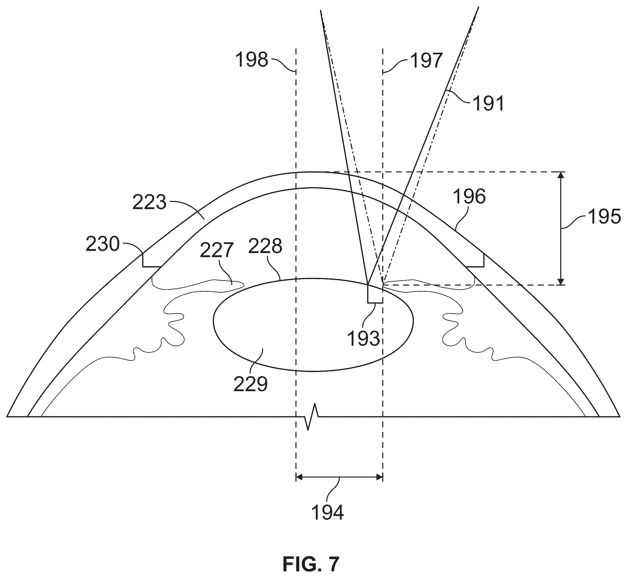 Patent US12350196 Figure 7 – Combined laser and phacoemulsification system for eye surgery