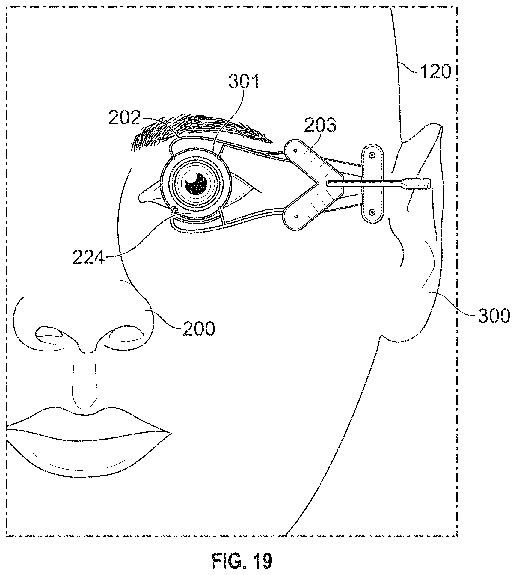 Patent US12350196 Figure 18 – Combined laser and phacoemulsification system for eye surgery