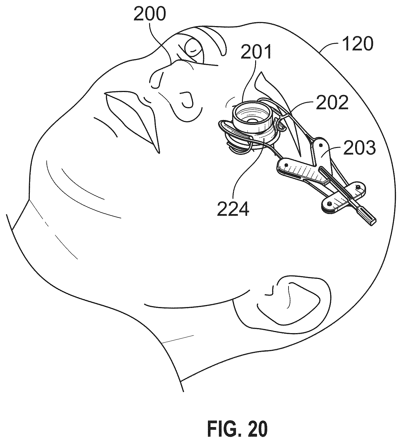 Patent US12350196 Figure 19 – Combined laser and phacoemulsification system for eye surgery