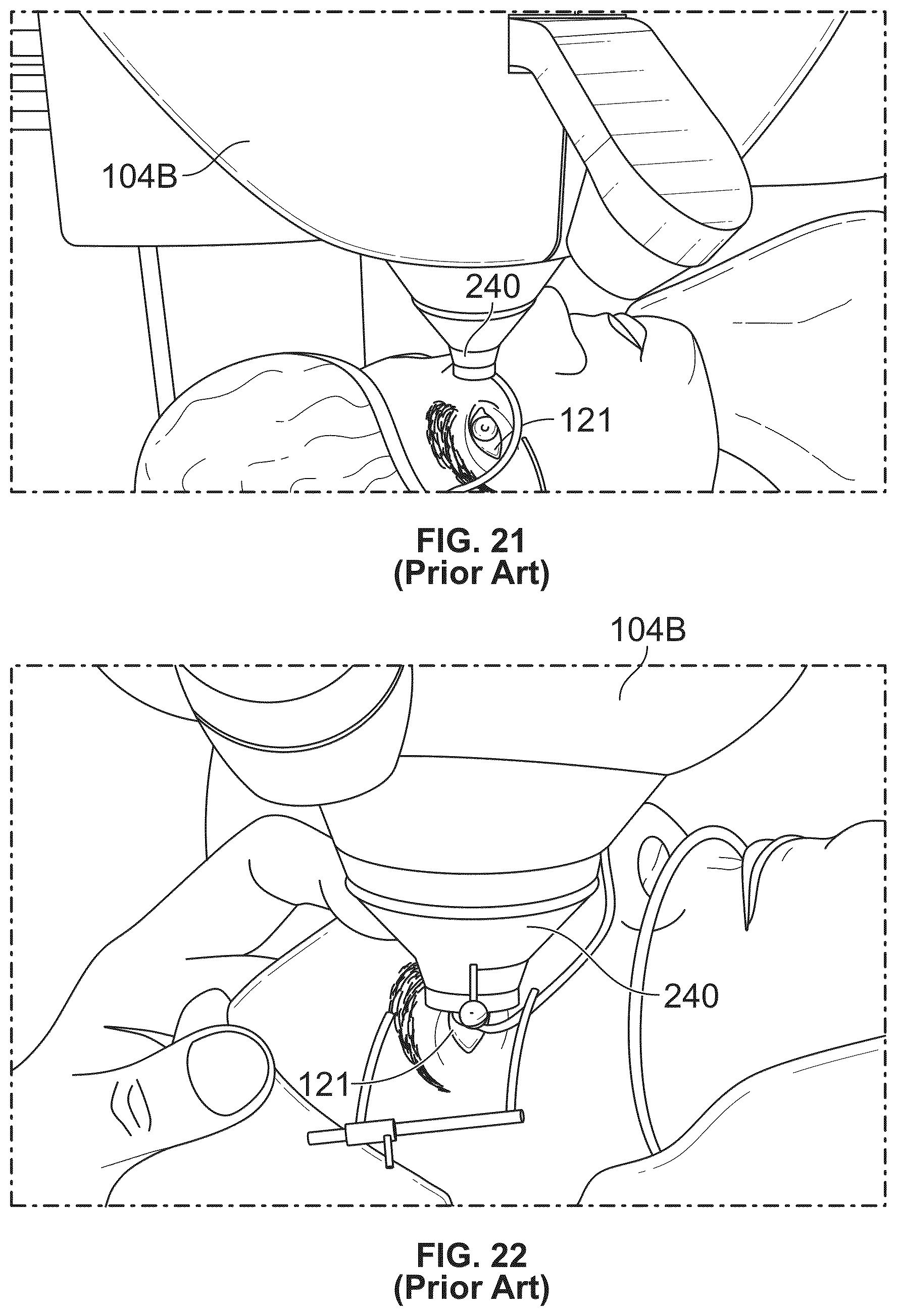 Patent US12350196 Figure 20 – Combined laser and phacoemulsification system for eye surgery