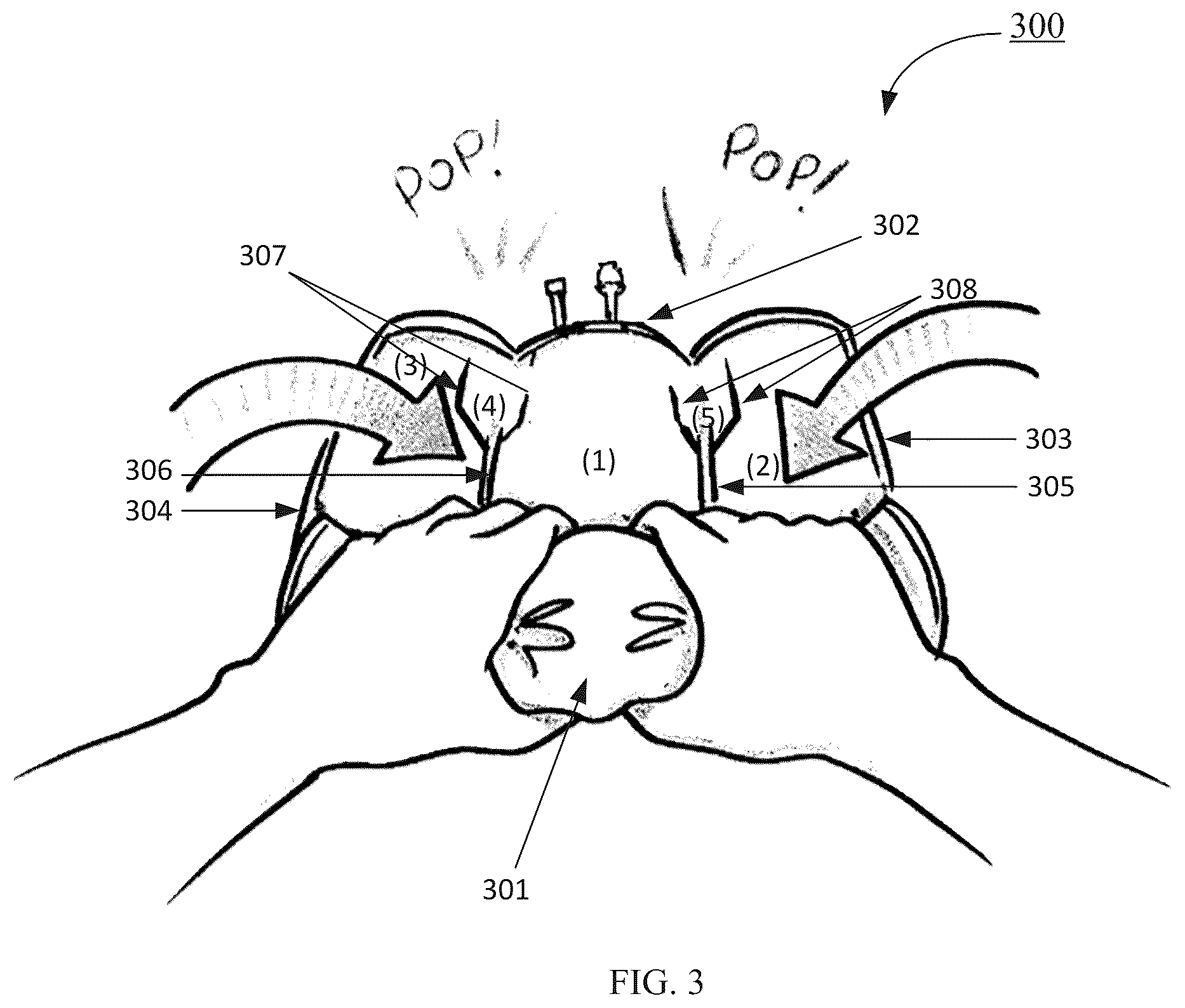 Patent US12350236 Figure 6 – Multi-chamber bag for parenteral nutrition solutions