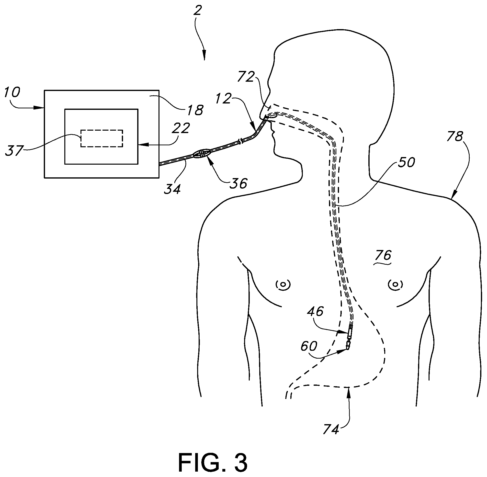 Patent US12350238 Figure 3 – System and method for real-time humidity and temperature sensing to verify proper nasogastric tube placement