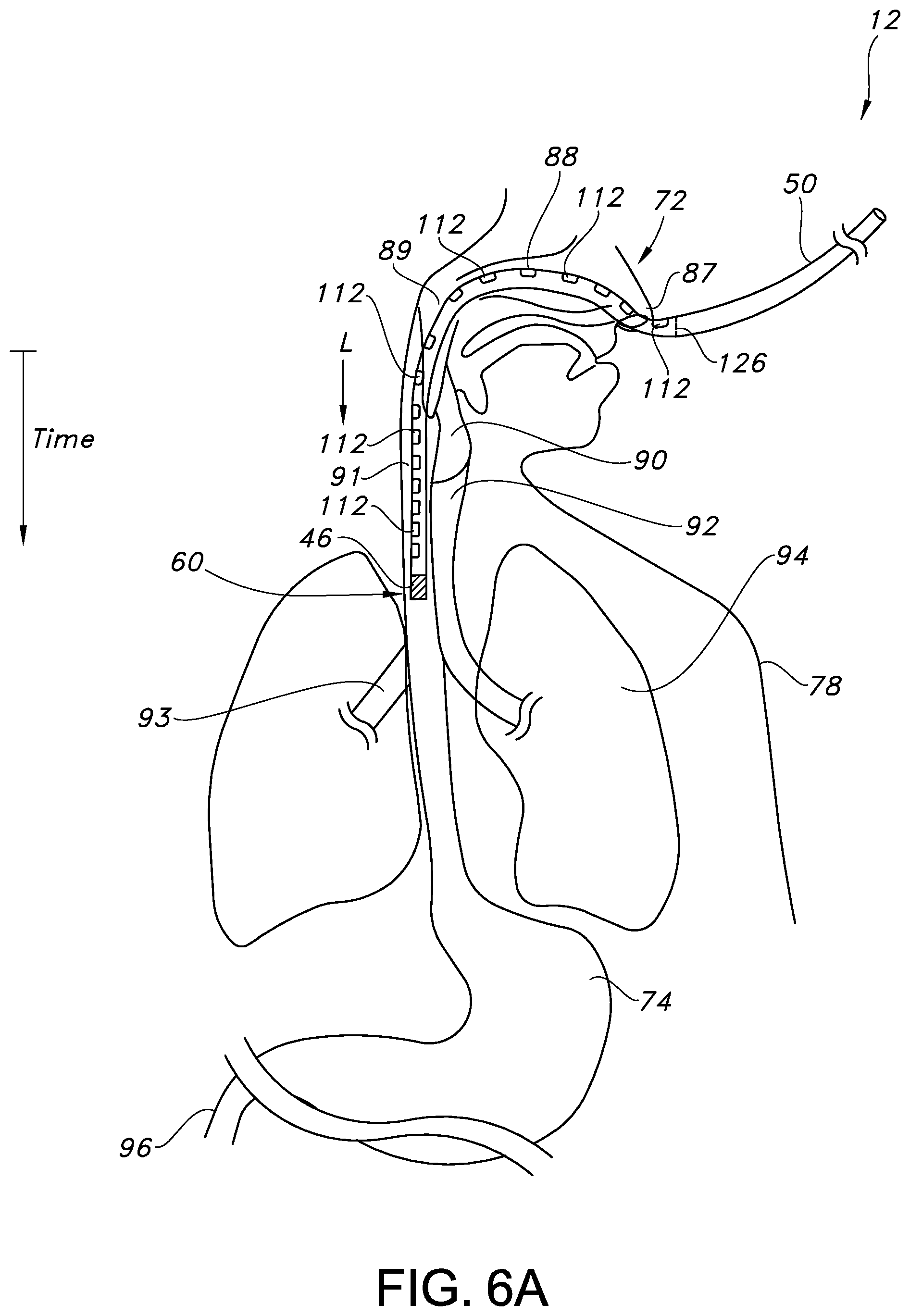 Patent US12350238 Figure 6 – System and method for real-time humidity and temperature sensing to verify proper nasogastric tube placement