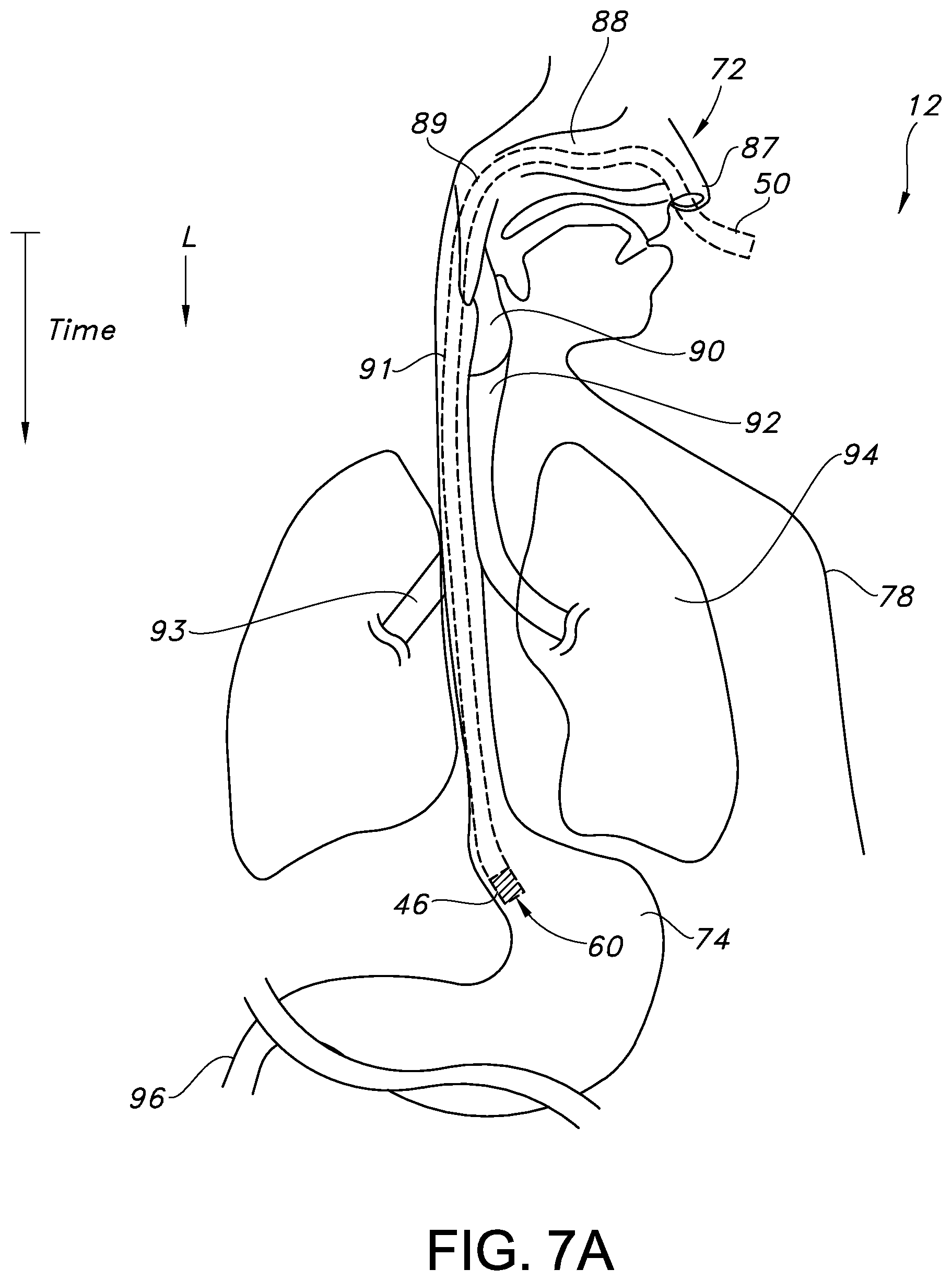 Patent US12350238 Figure 9 – System and method for real-time humidity and temperature sensing to verify proper nasogastric tube placement