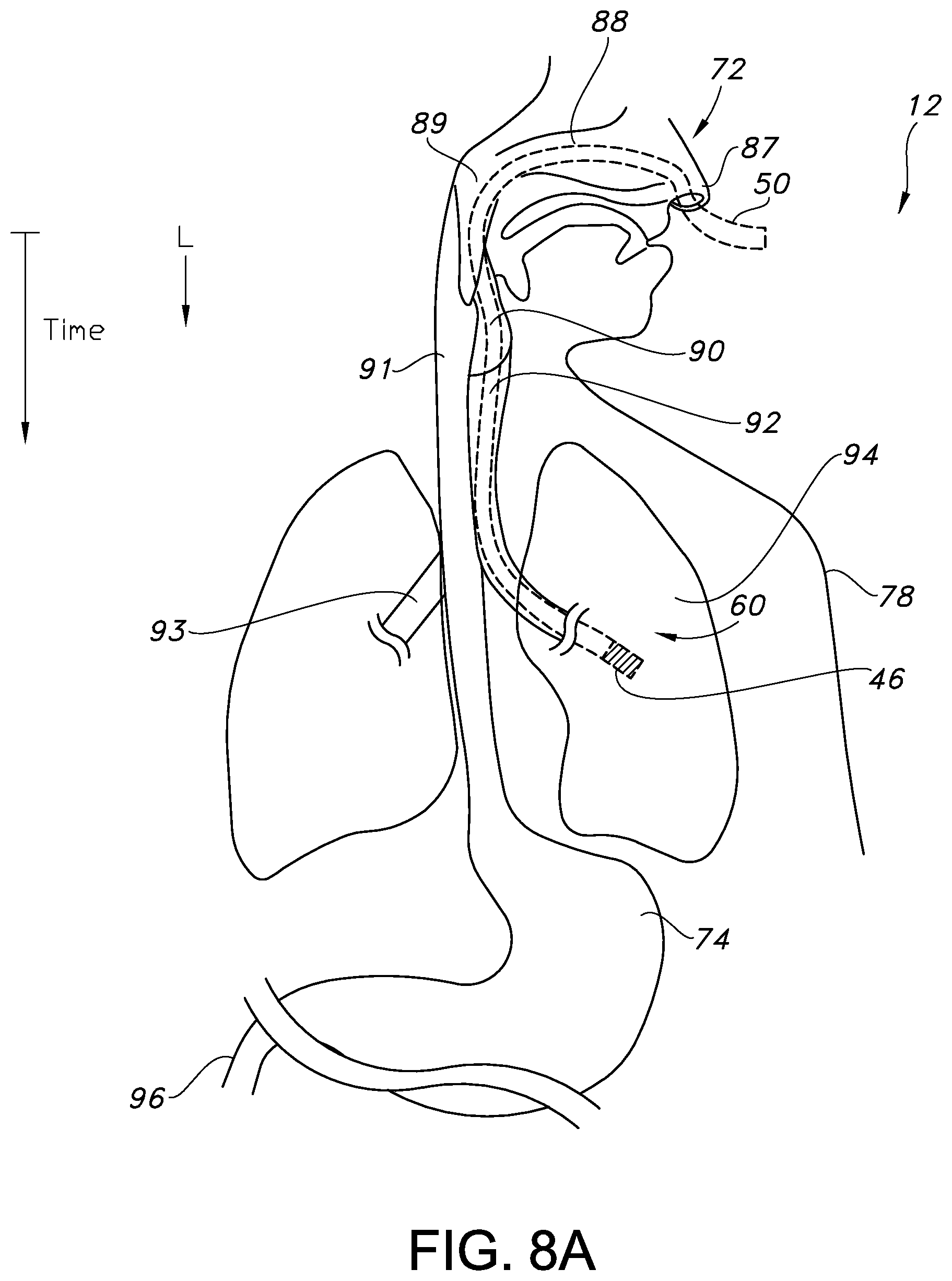 Patent US12350238 Figure 12 – System and method for real-time humidity and temperature sensing to verify proper nasogastric tube placement