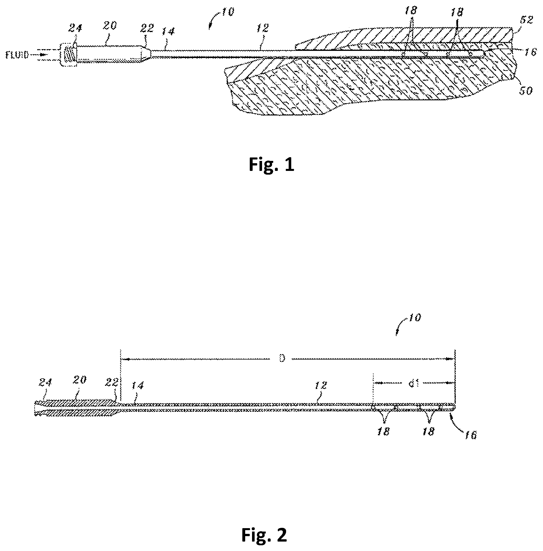 Patent US12350254 Figure 1 – Tumescent infiltration drug delivery of cannabinoids