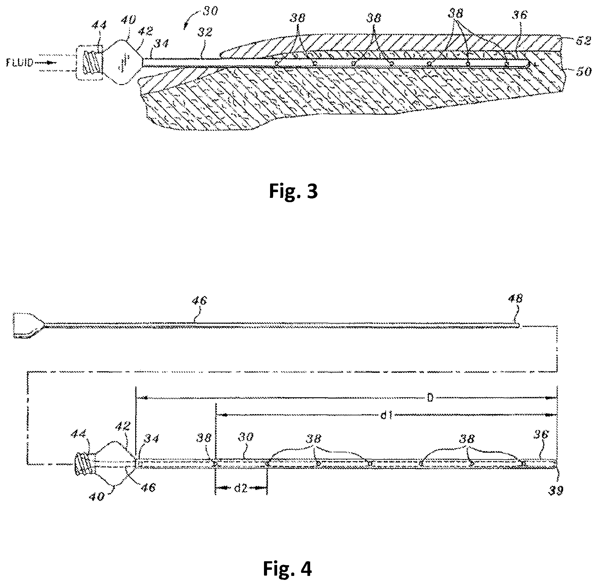 Patent US12350254 Figure 2 – Tumescent infiltration drug delivery of cannabinoids
