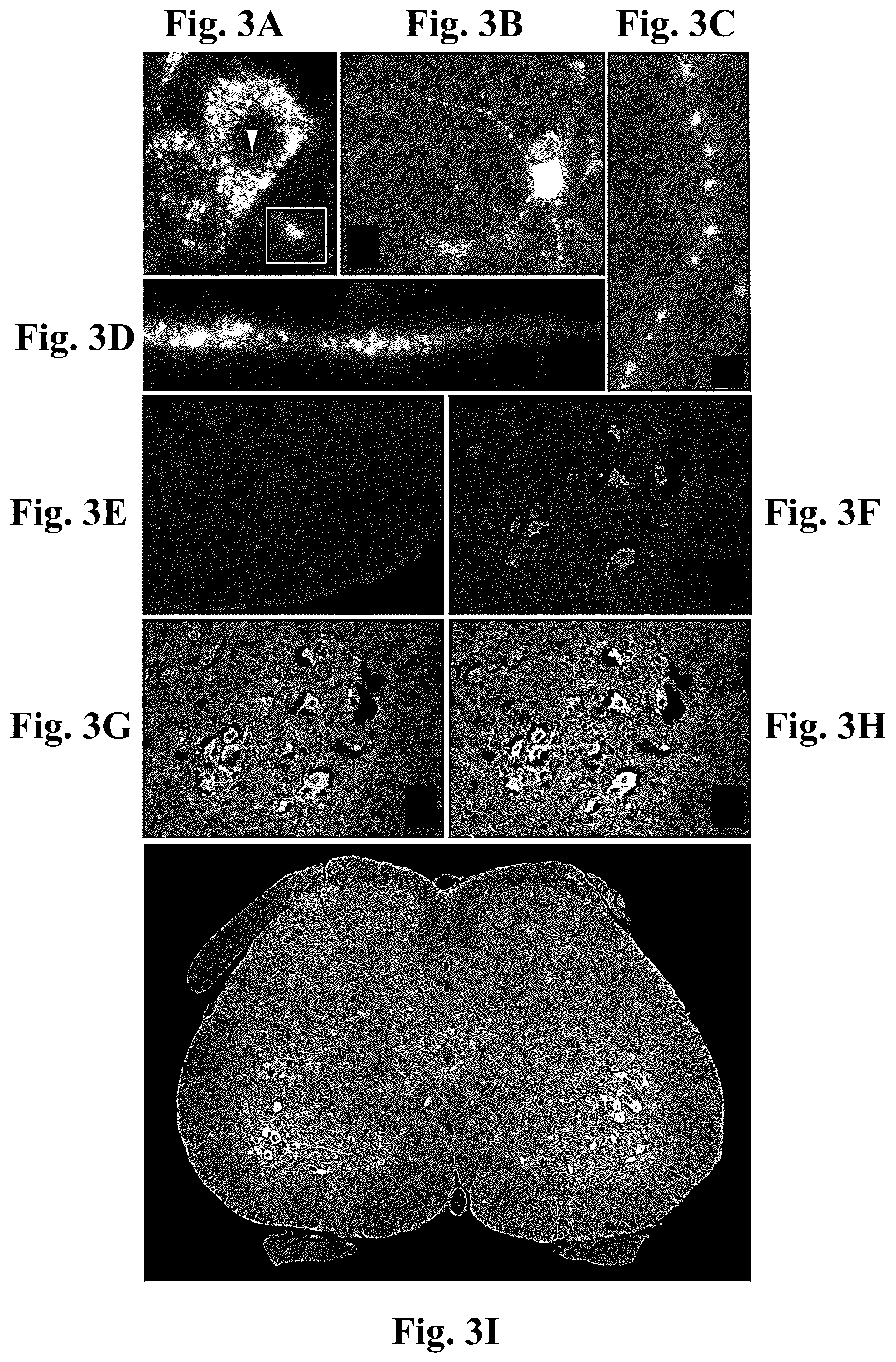 Patent US12350311 Figure 3 – Gene therapy for neurodegenerative disorders